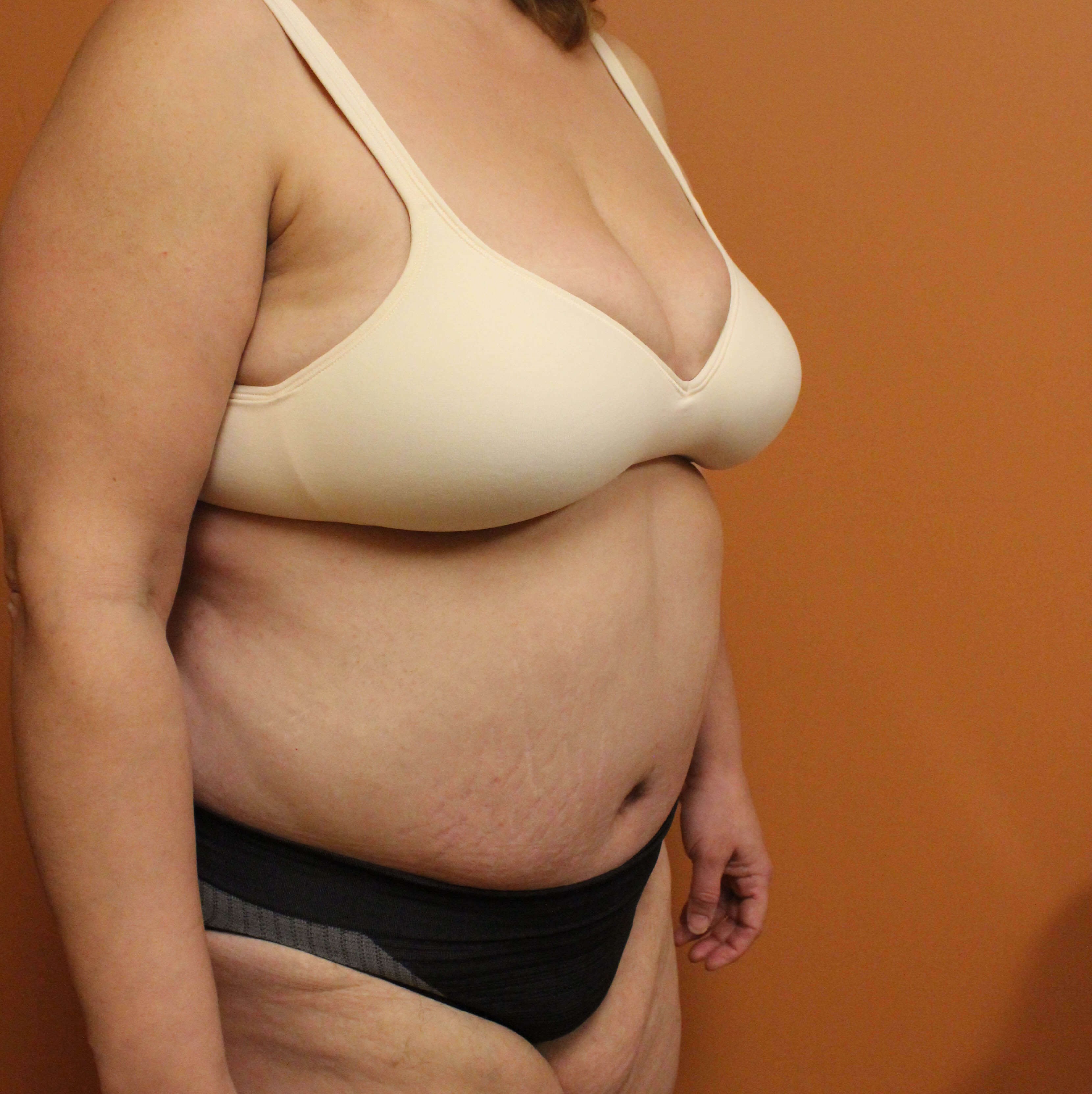 Tummy Tuck Surgery After