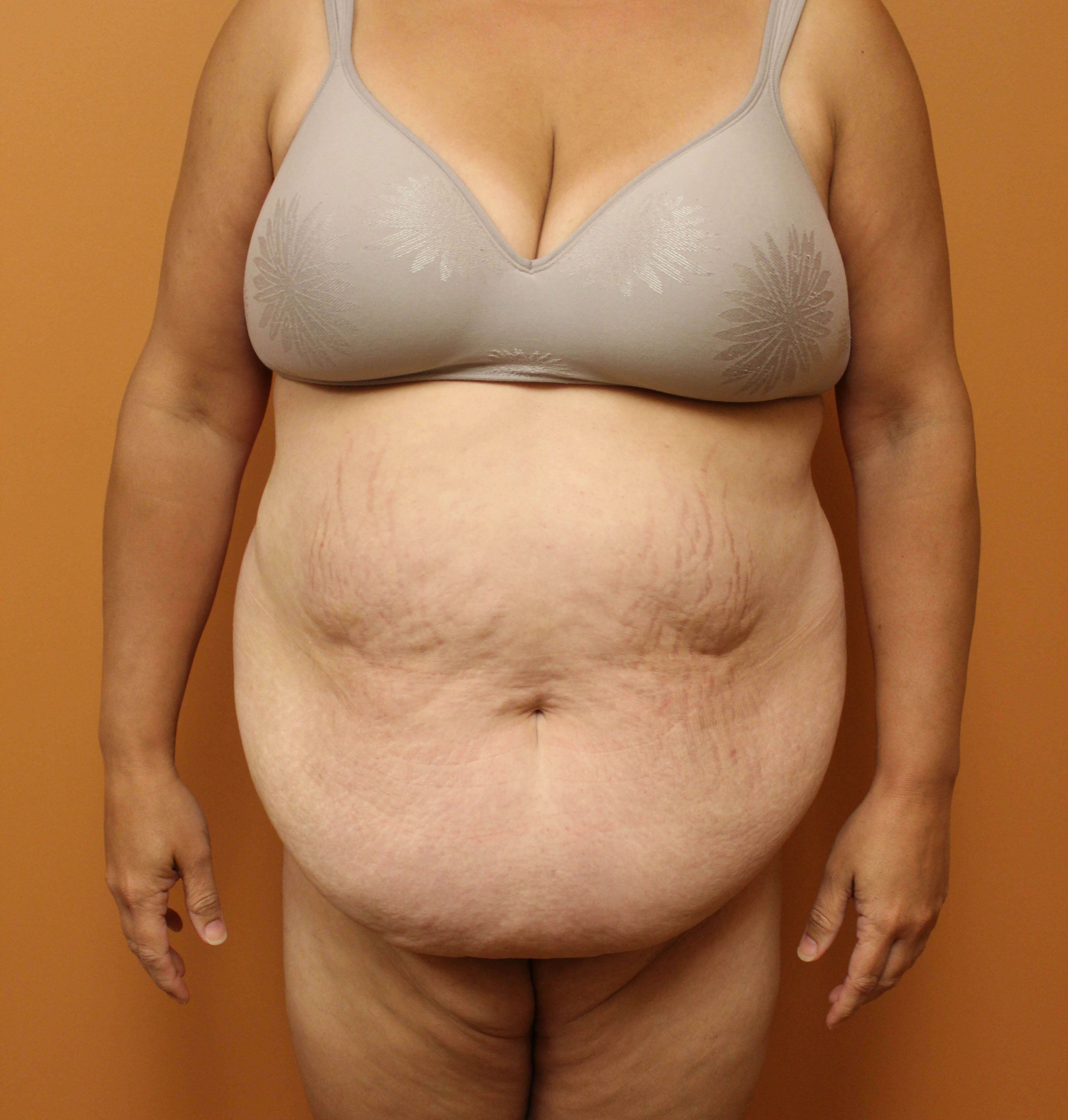 Tummy Tuck Surgery Before