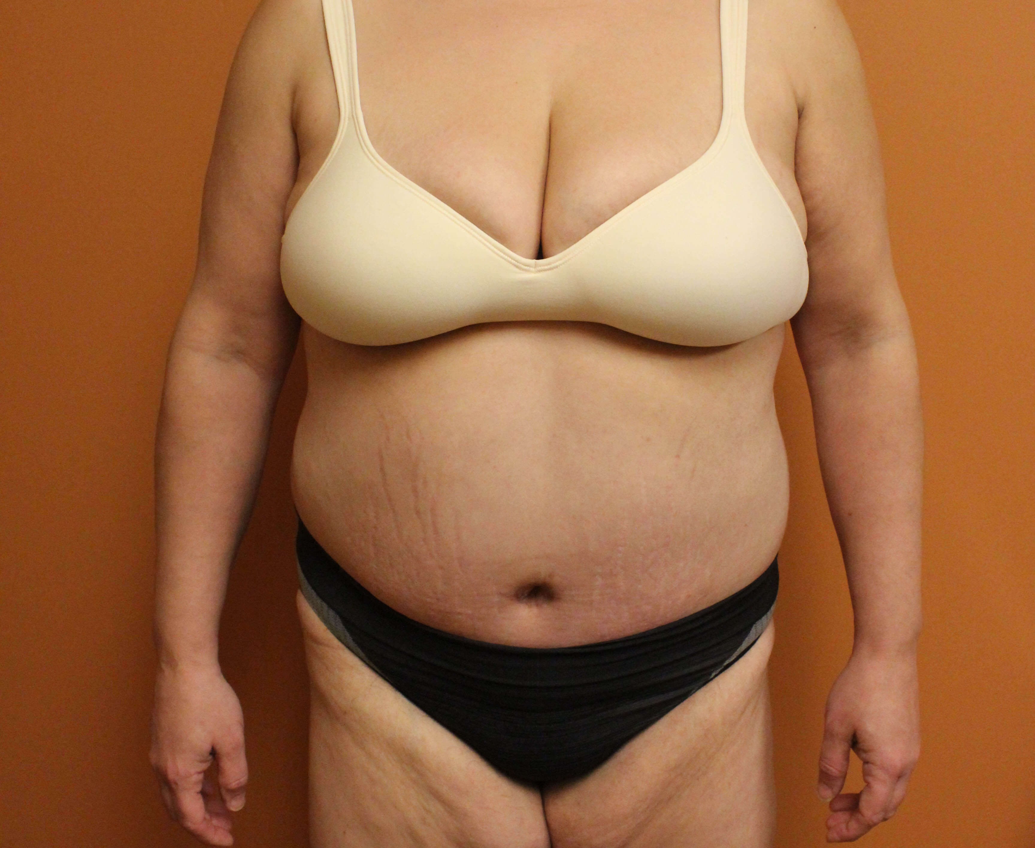 Tummy Tuck Surgery After