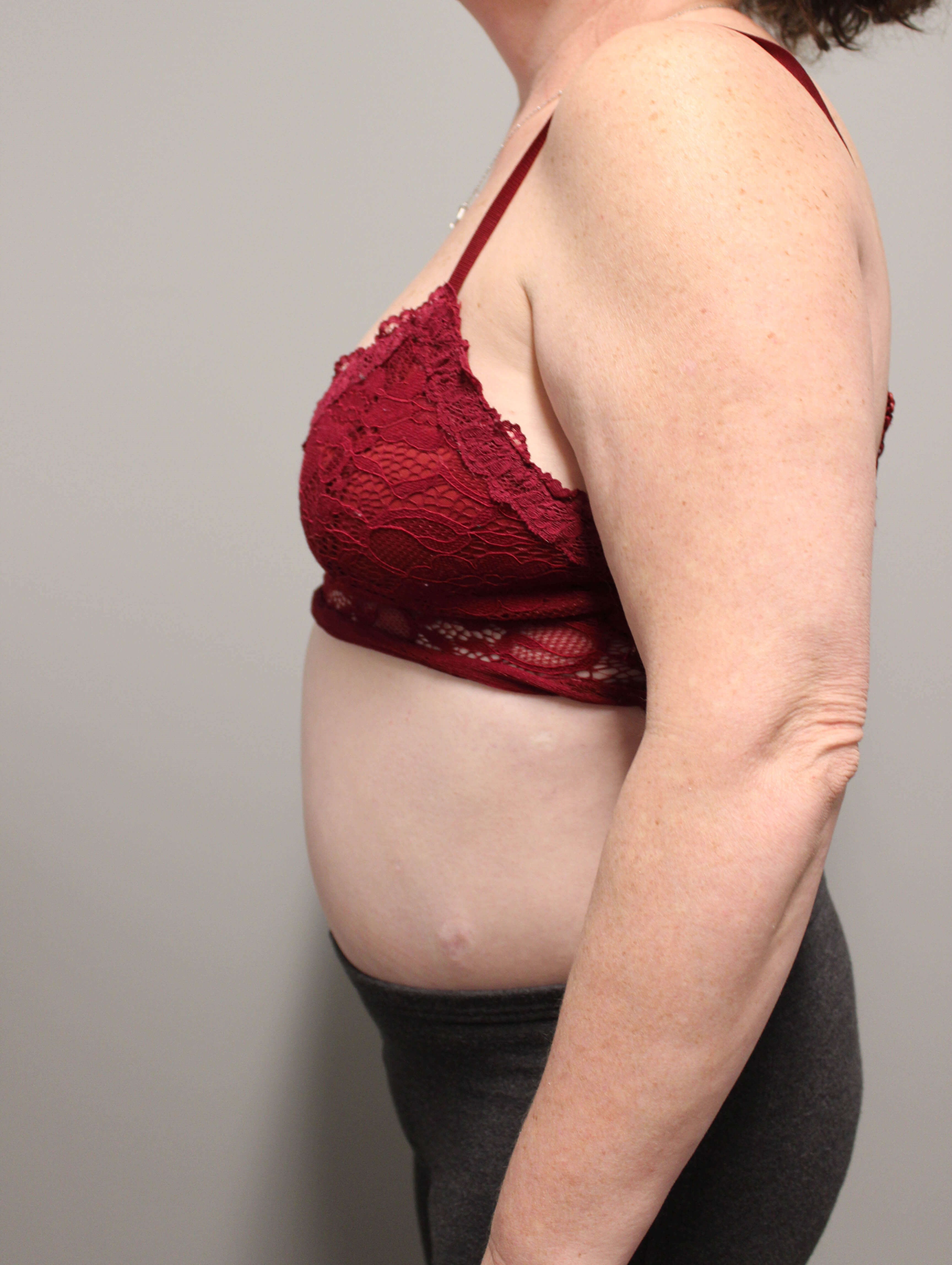 Tummy Tuck after weight loss After