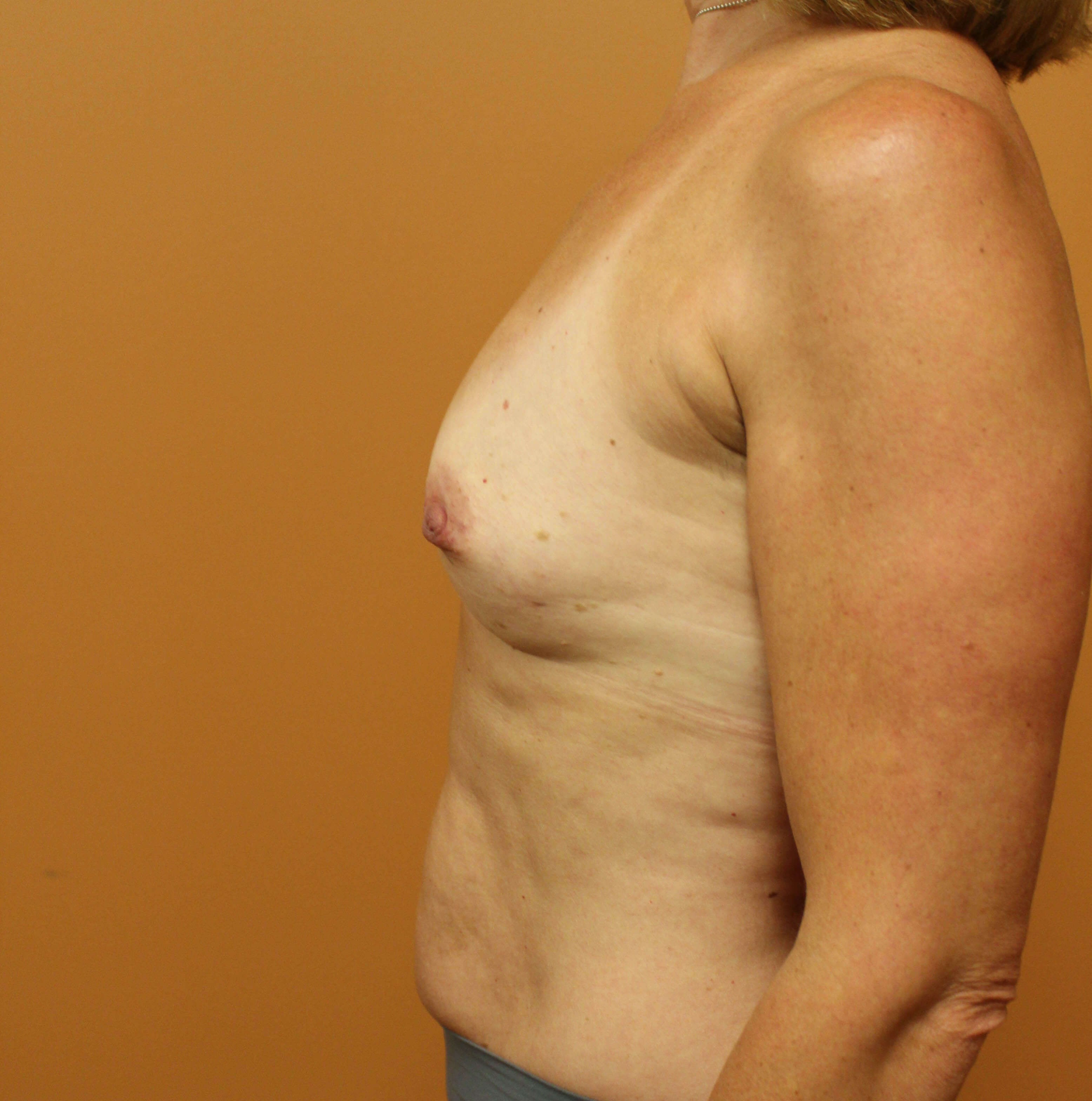 Tissue Expander to Implant Before