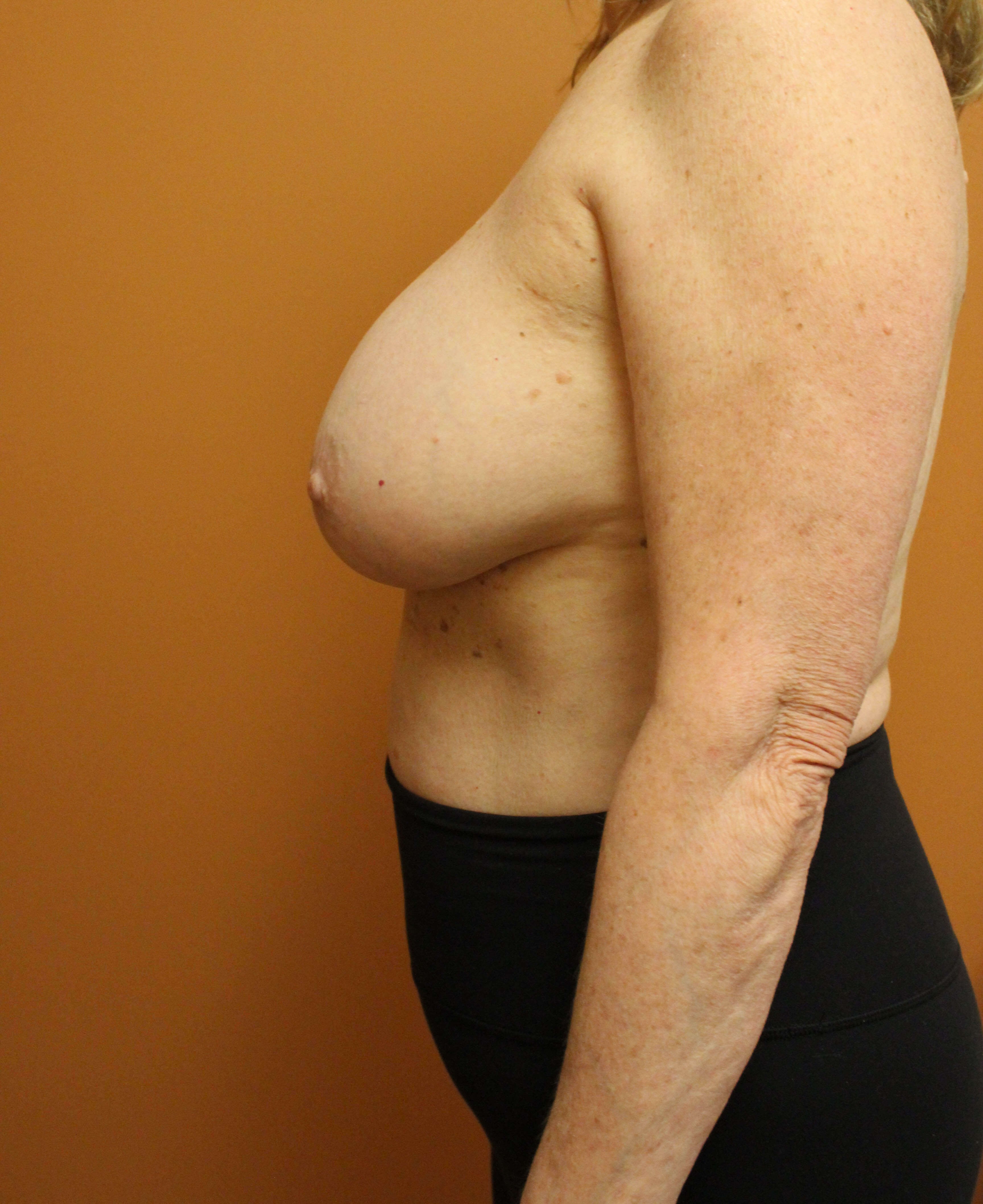 Removal of Breast Implants Before