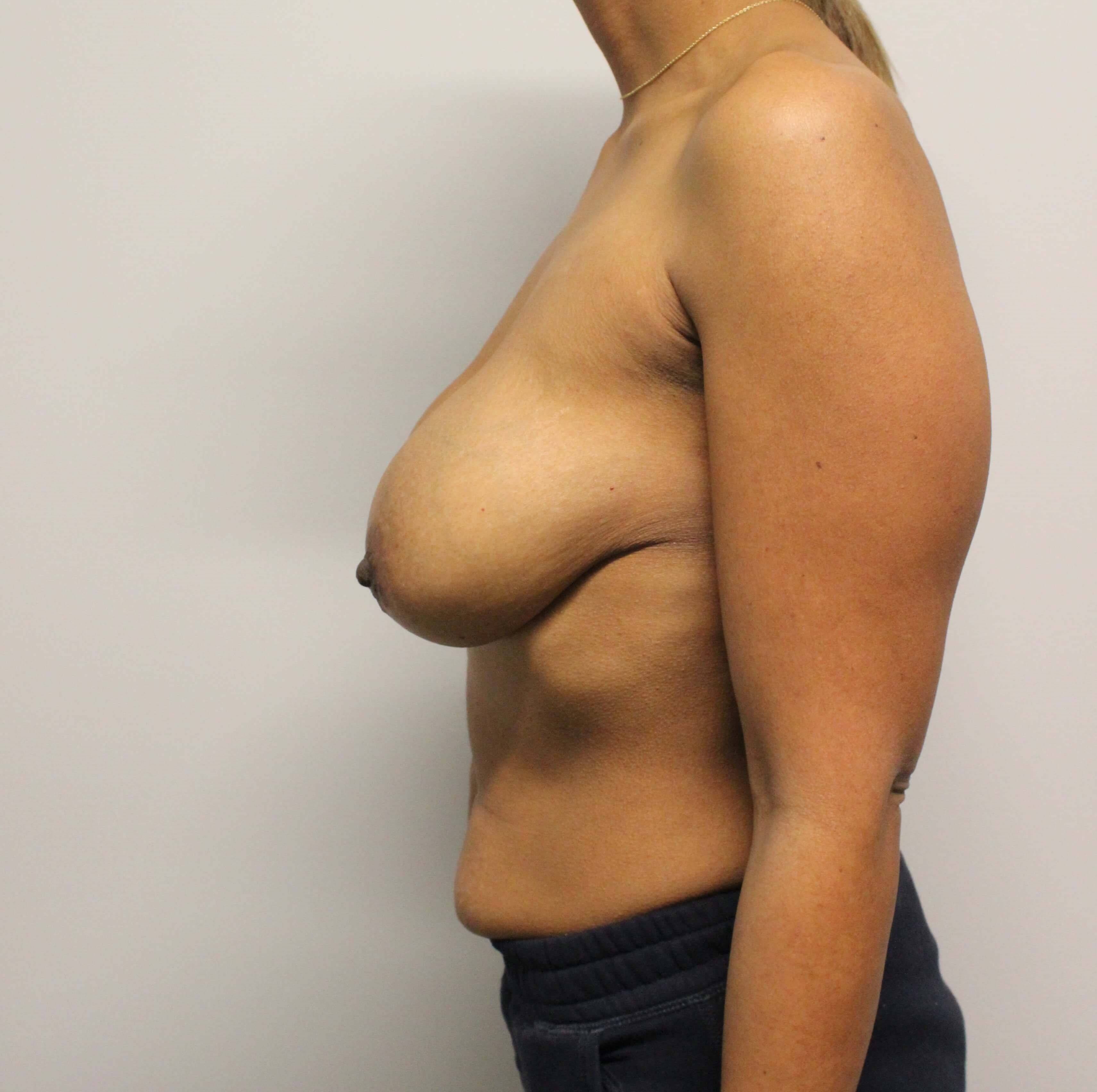 Breast Lift and Fat Transfer Before