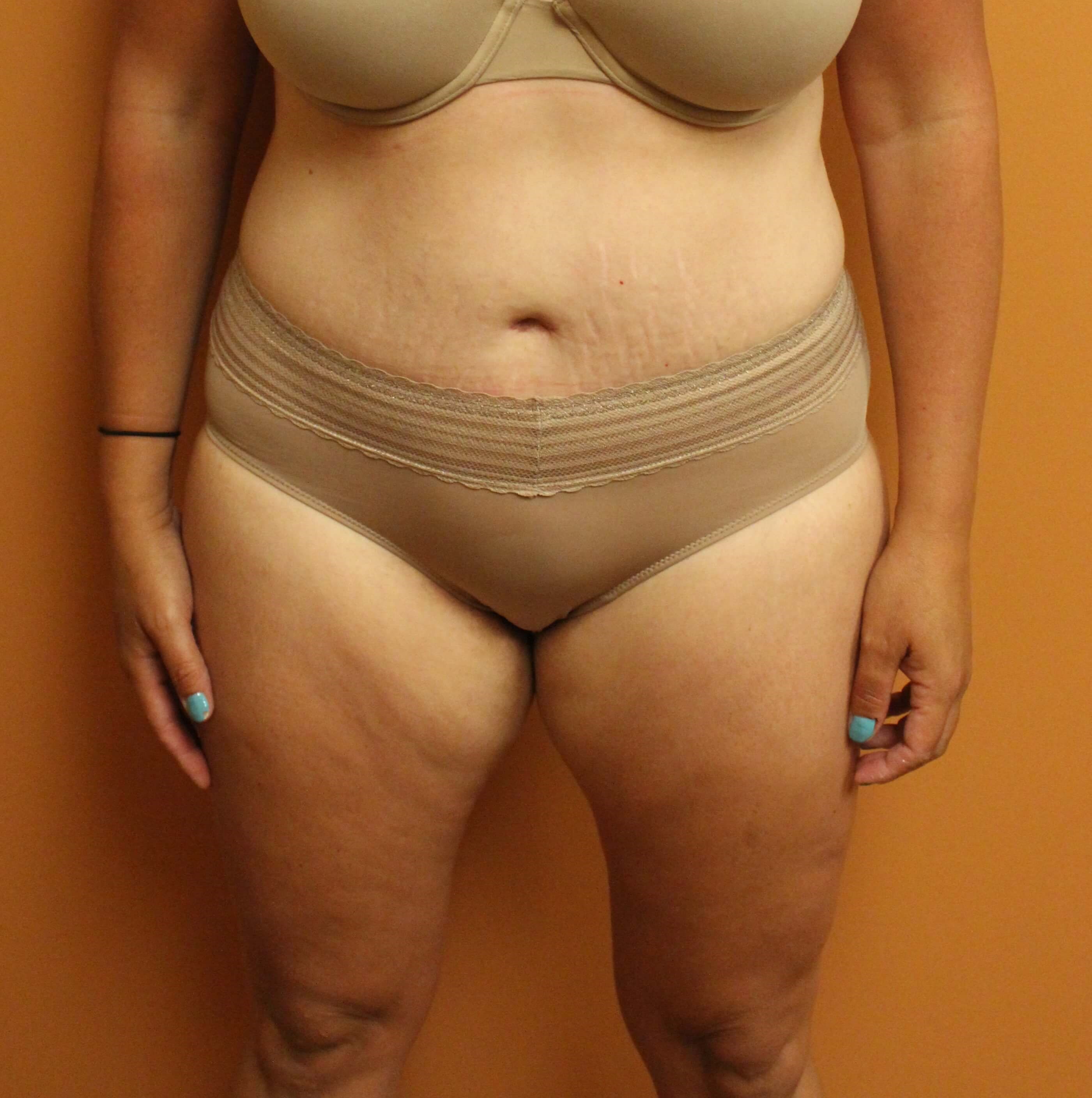 Tummy Tuck at 40 After