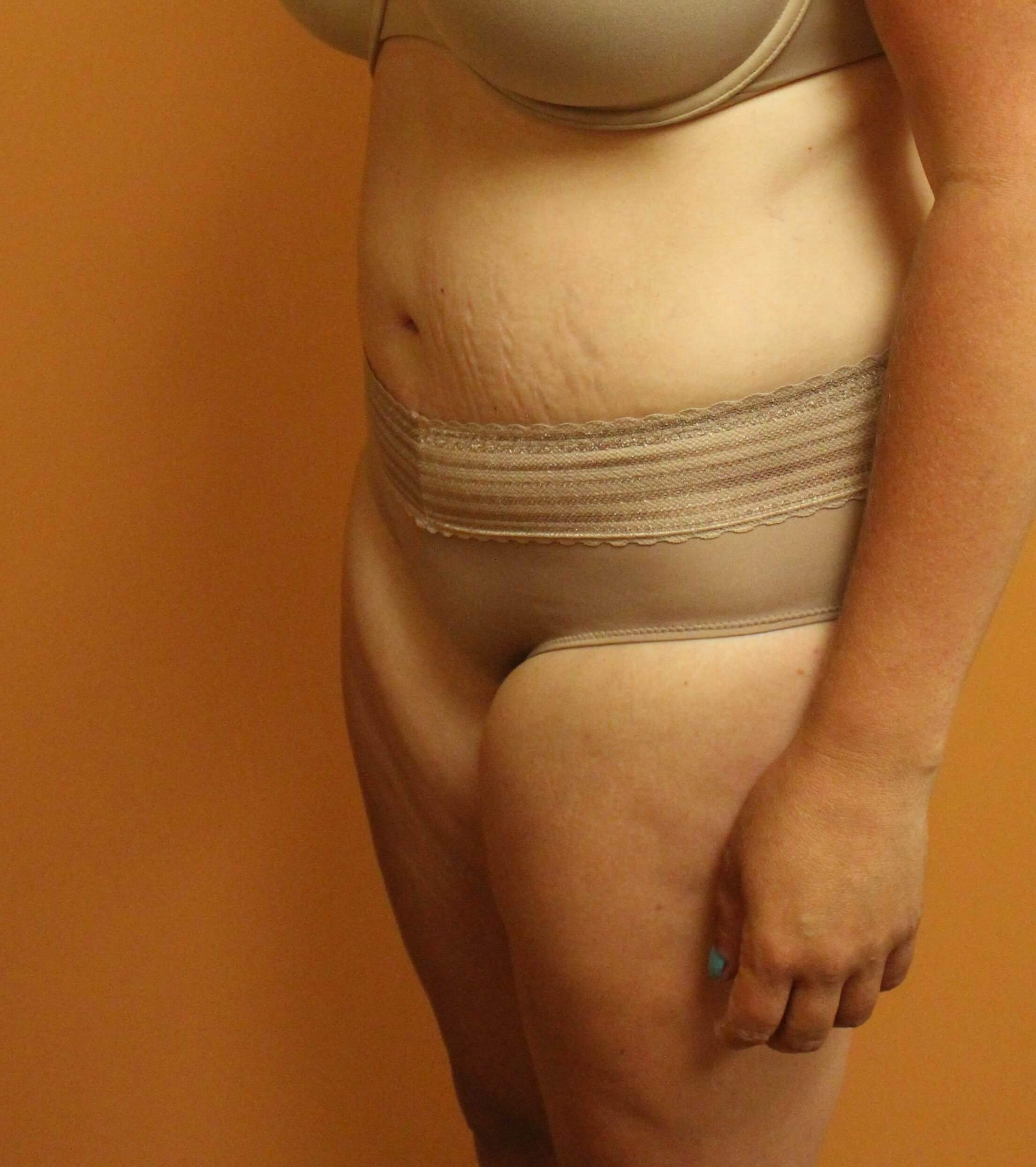 Tummy Tuck at 40 After