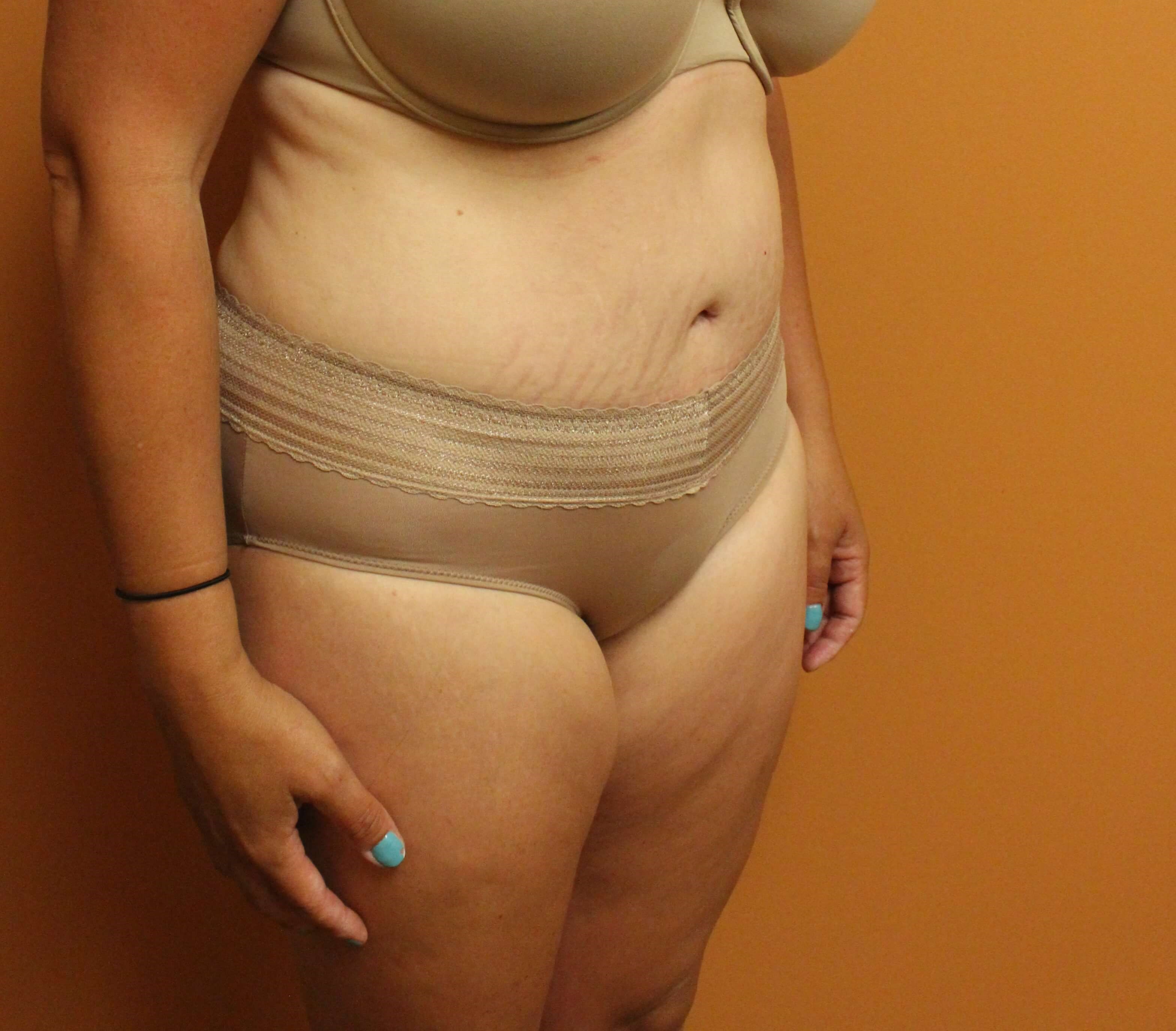 Tummy Tuck at 40 After