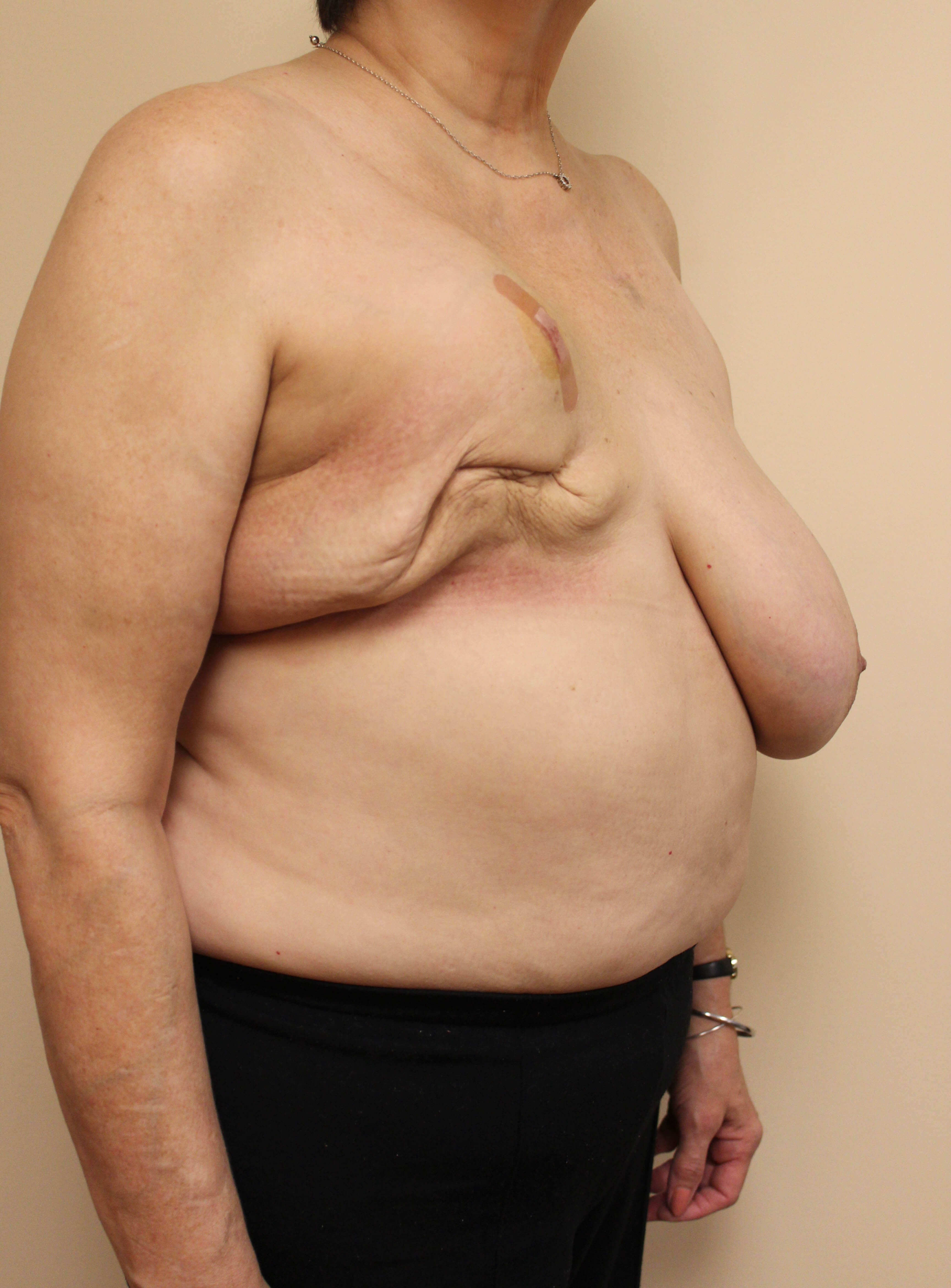 DIEP Flap Reconstruction Before