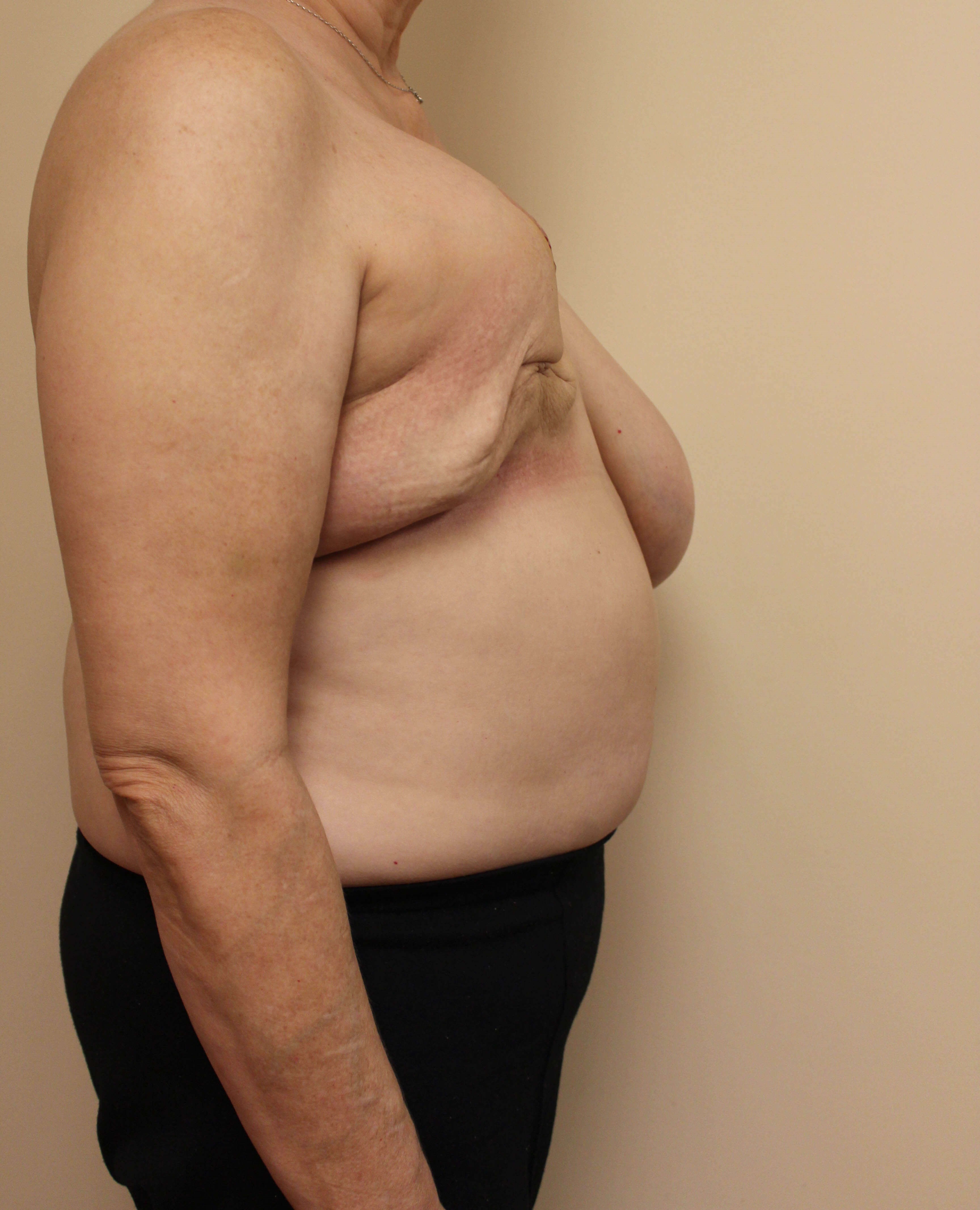 DIEP Flap Reconstruction Before