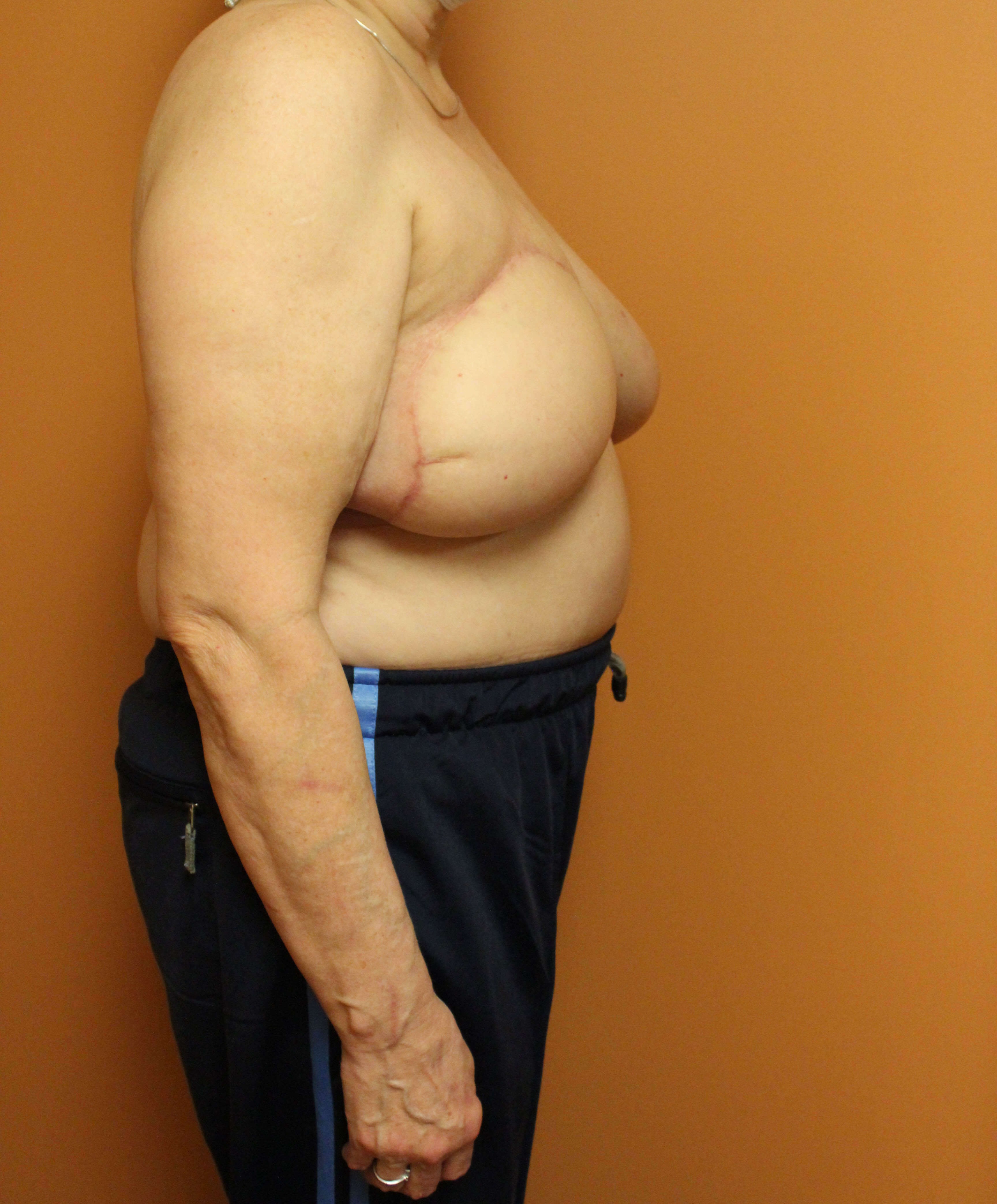 DIEP Flap Reconstruction After