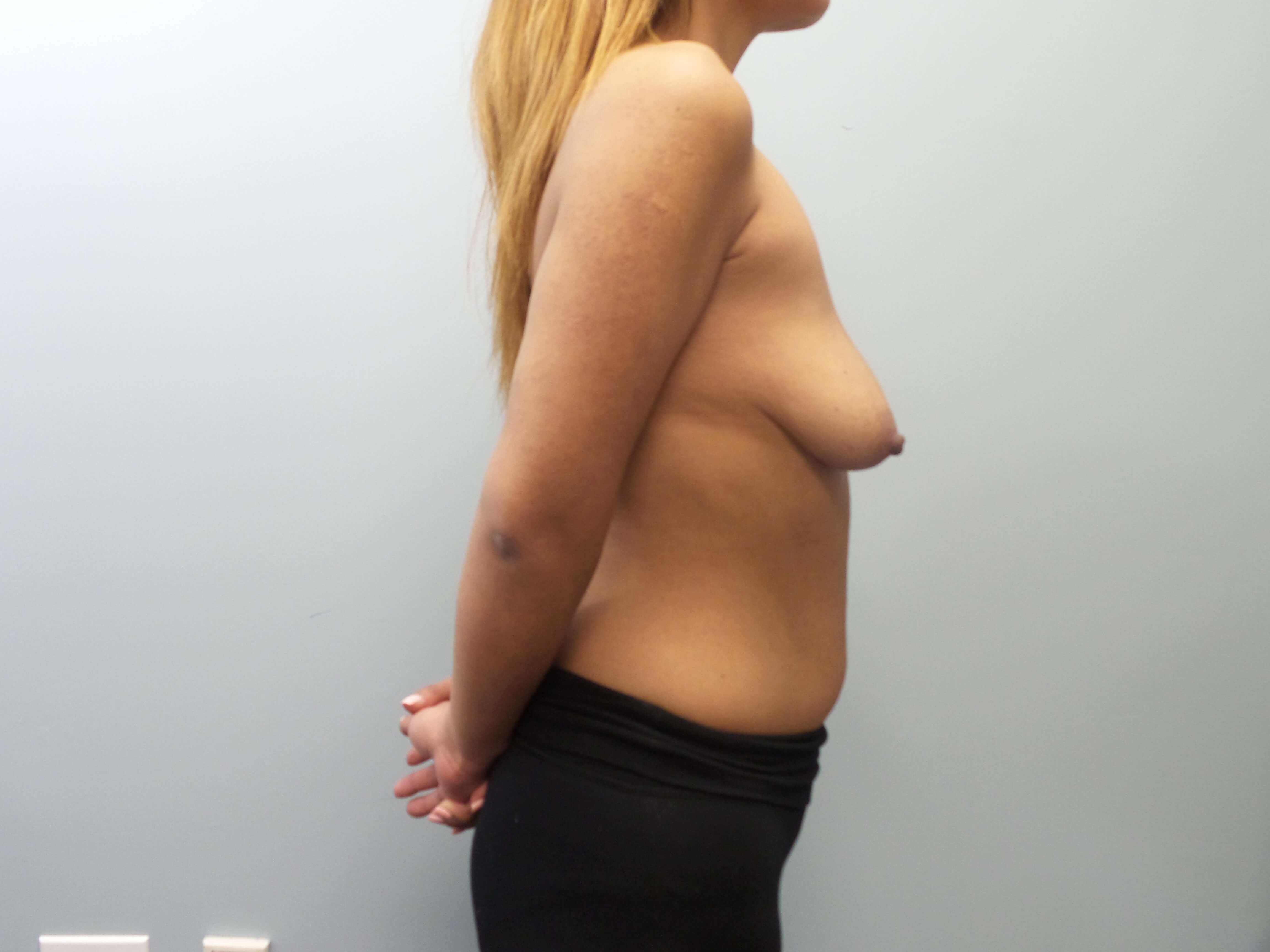 Breast Augmentation Before
