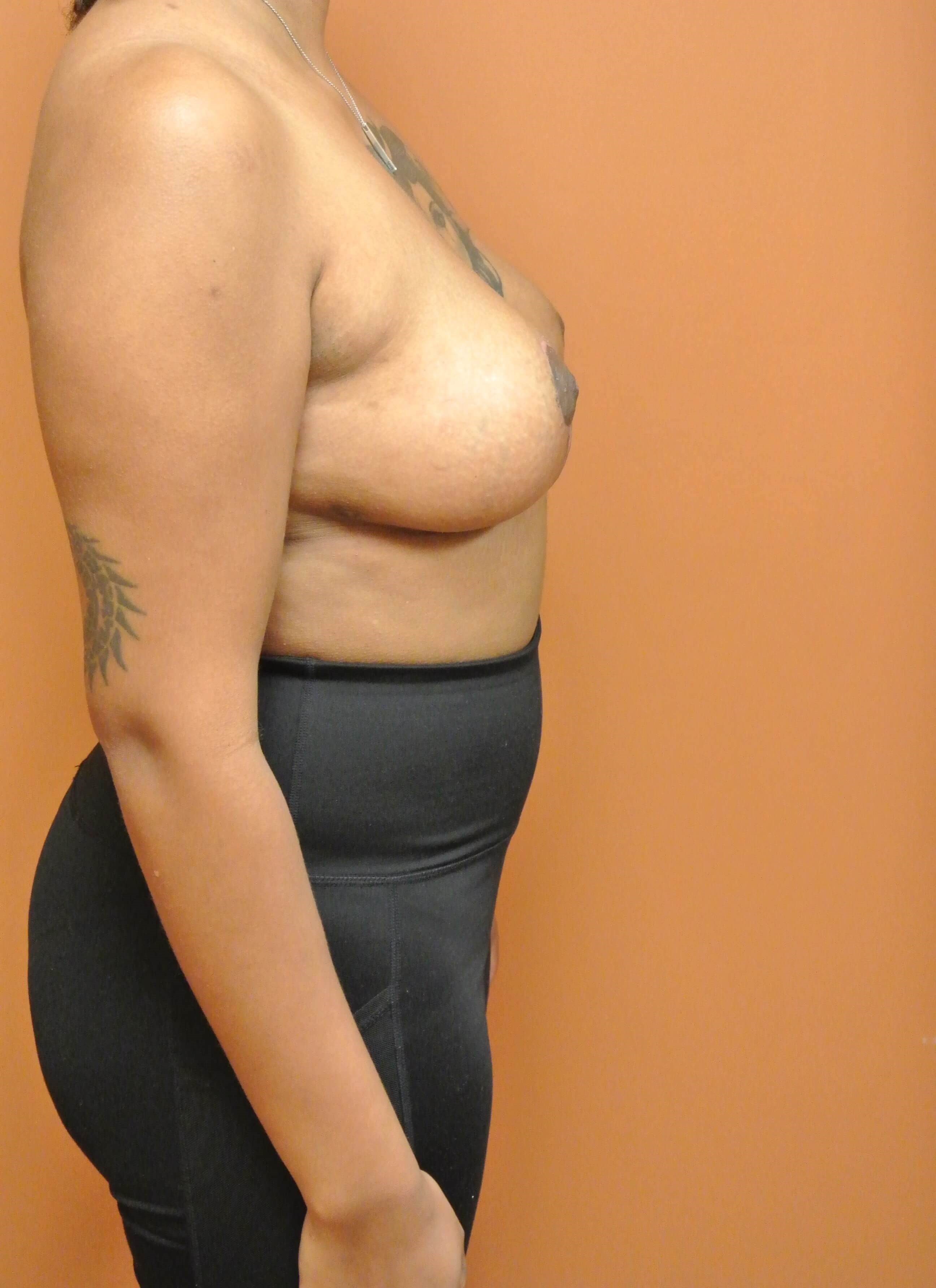 Breast Lift after Baby After