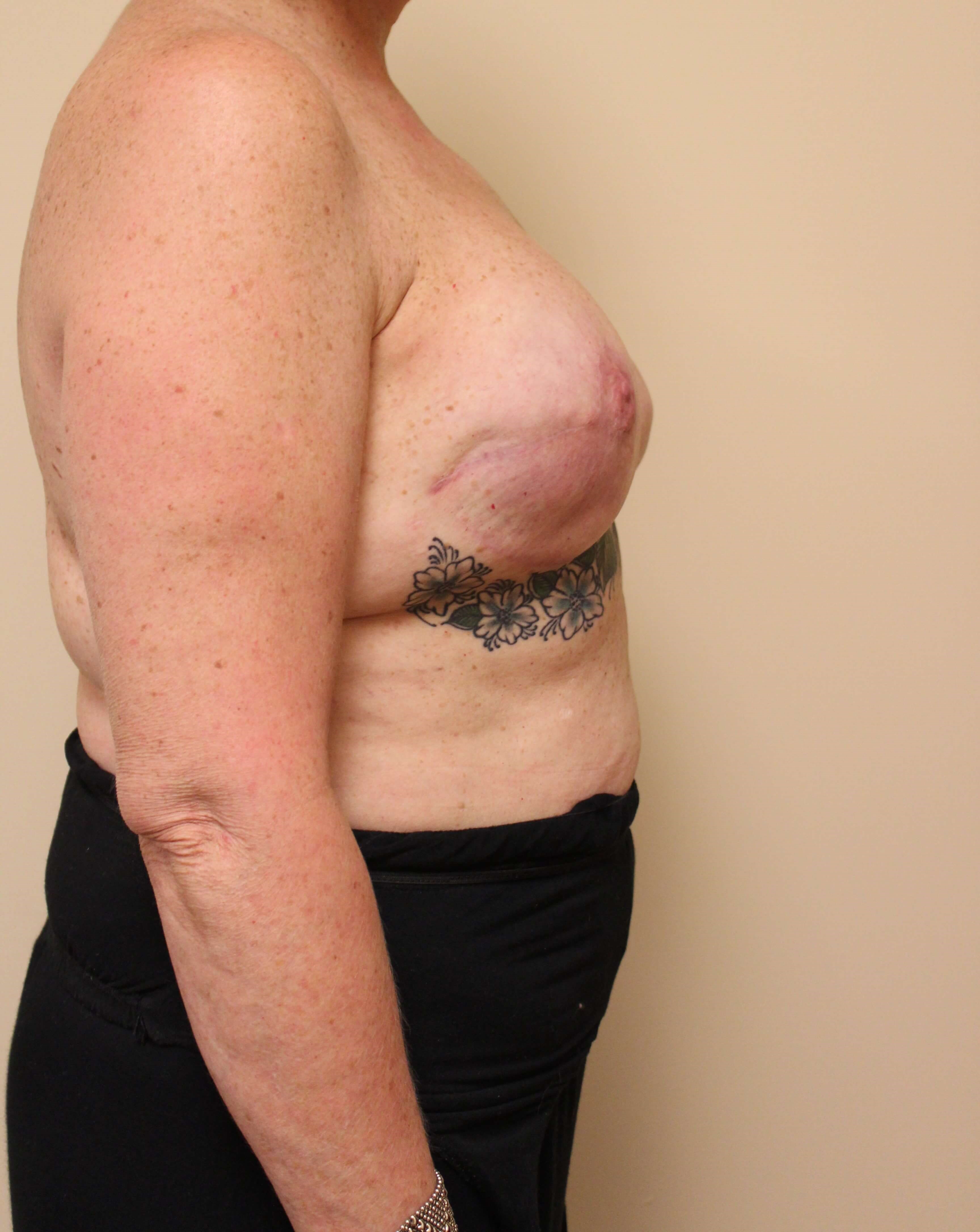 Revision Reconstructed Breasts Before