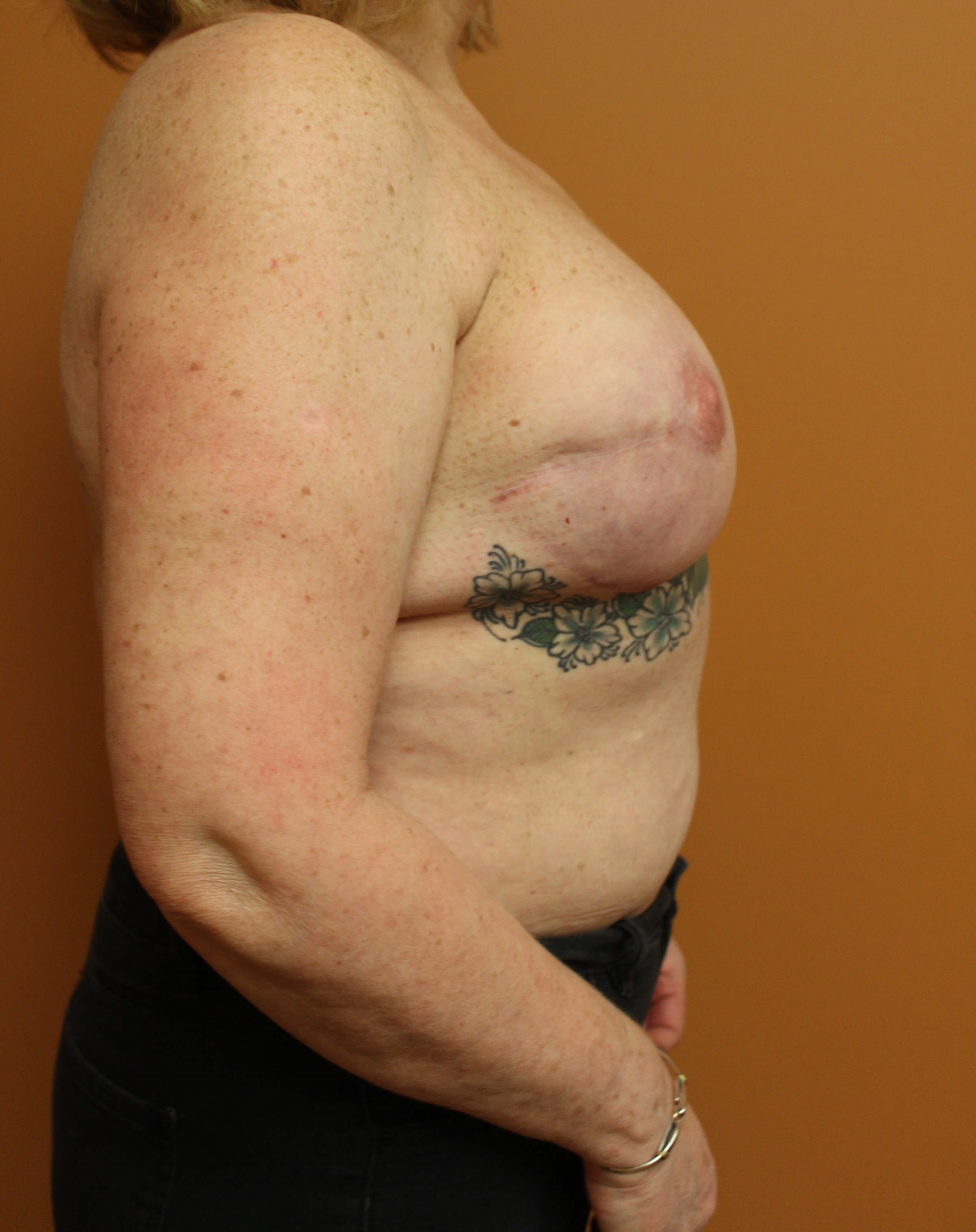 Revision Reconstructed Breasts After