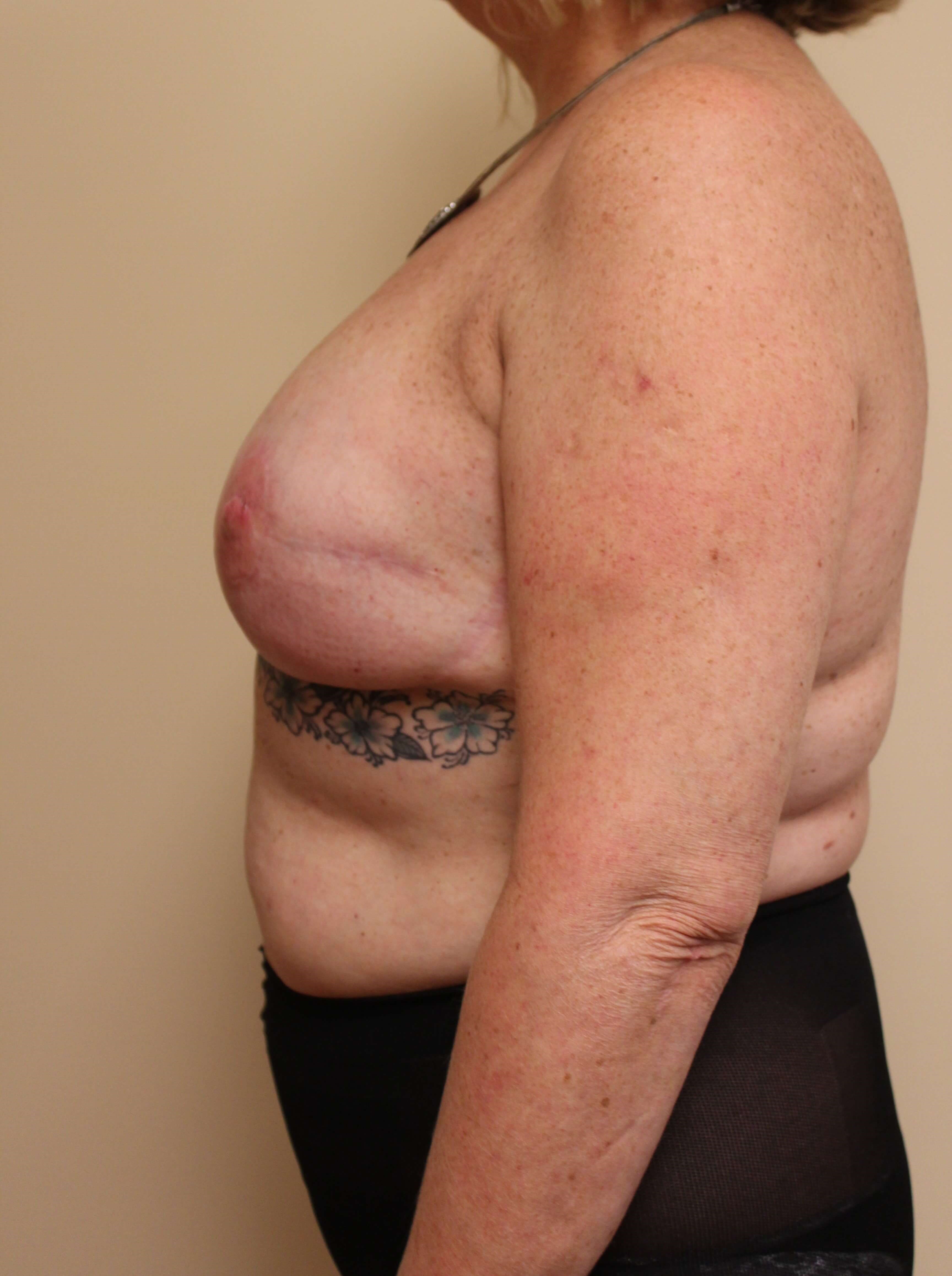 Revision Reconstructed Breasts Before