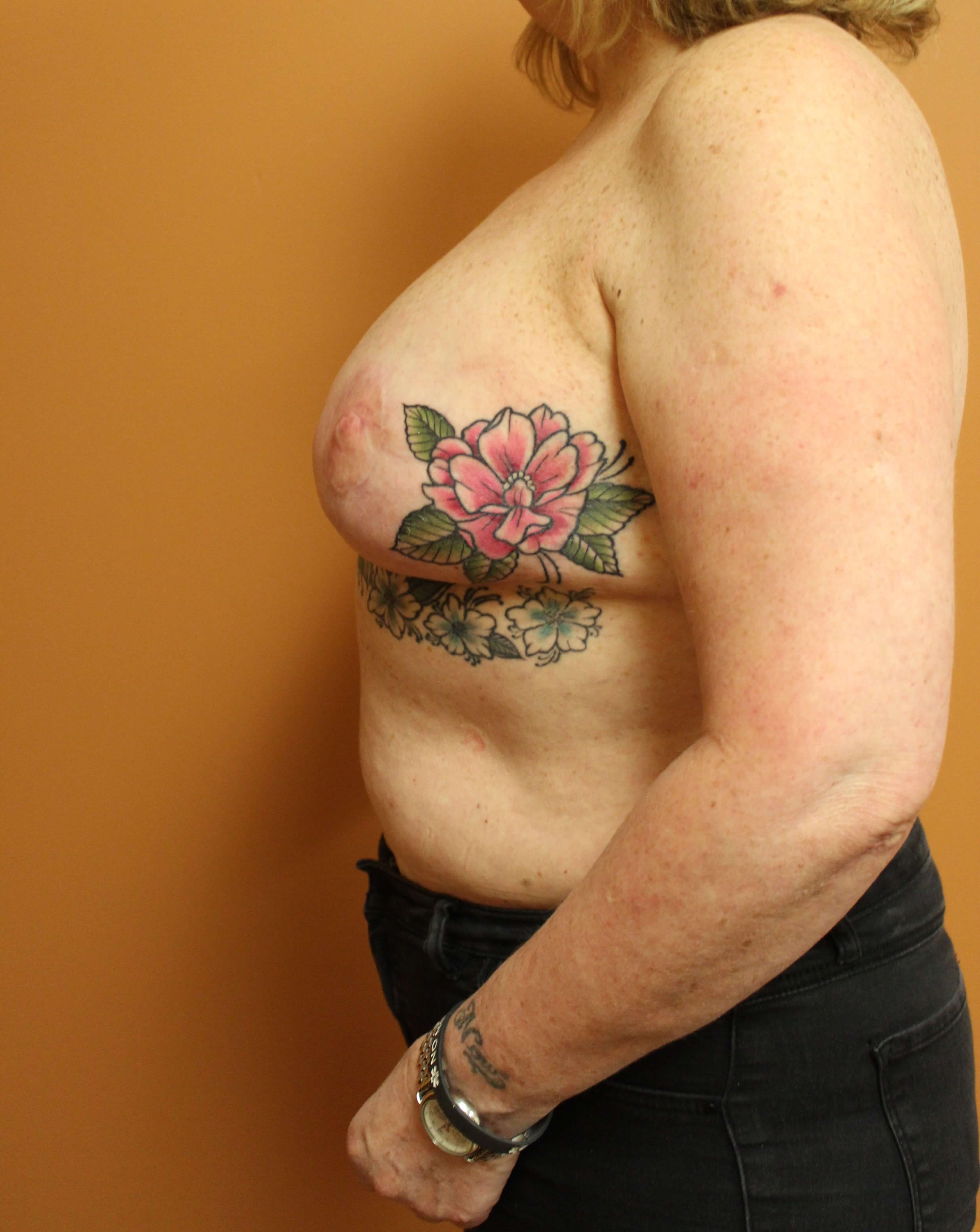 Revision Reconstructed Breasts After