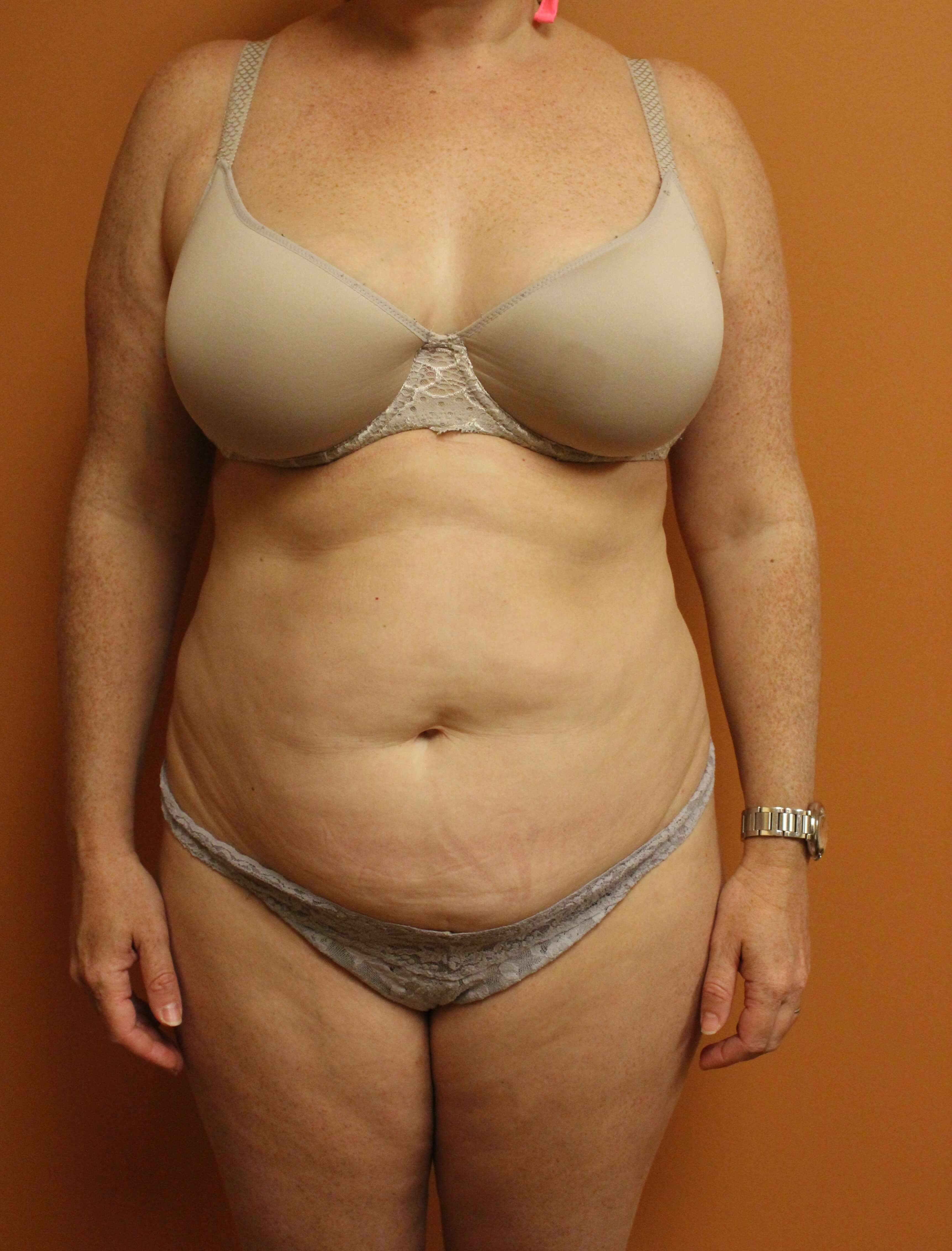 Tummy Tuck with Liposuction Before