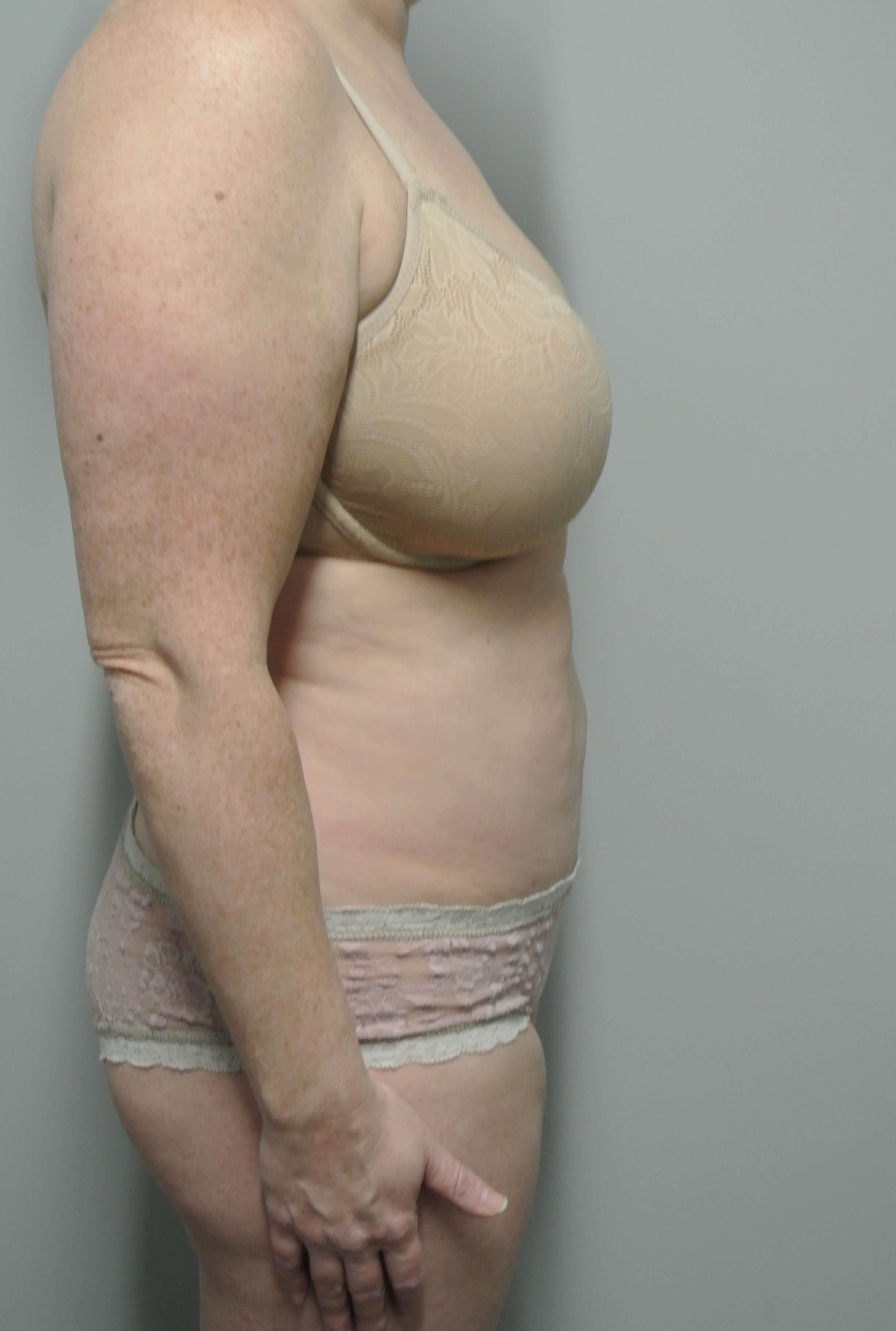 Tummy Tuck with Liposuction After