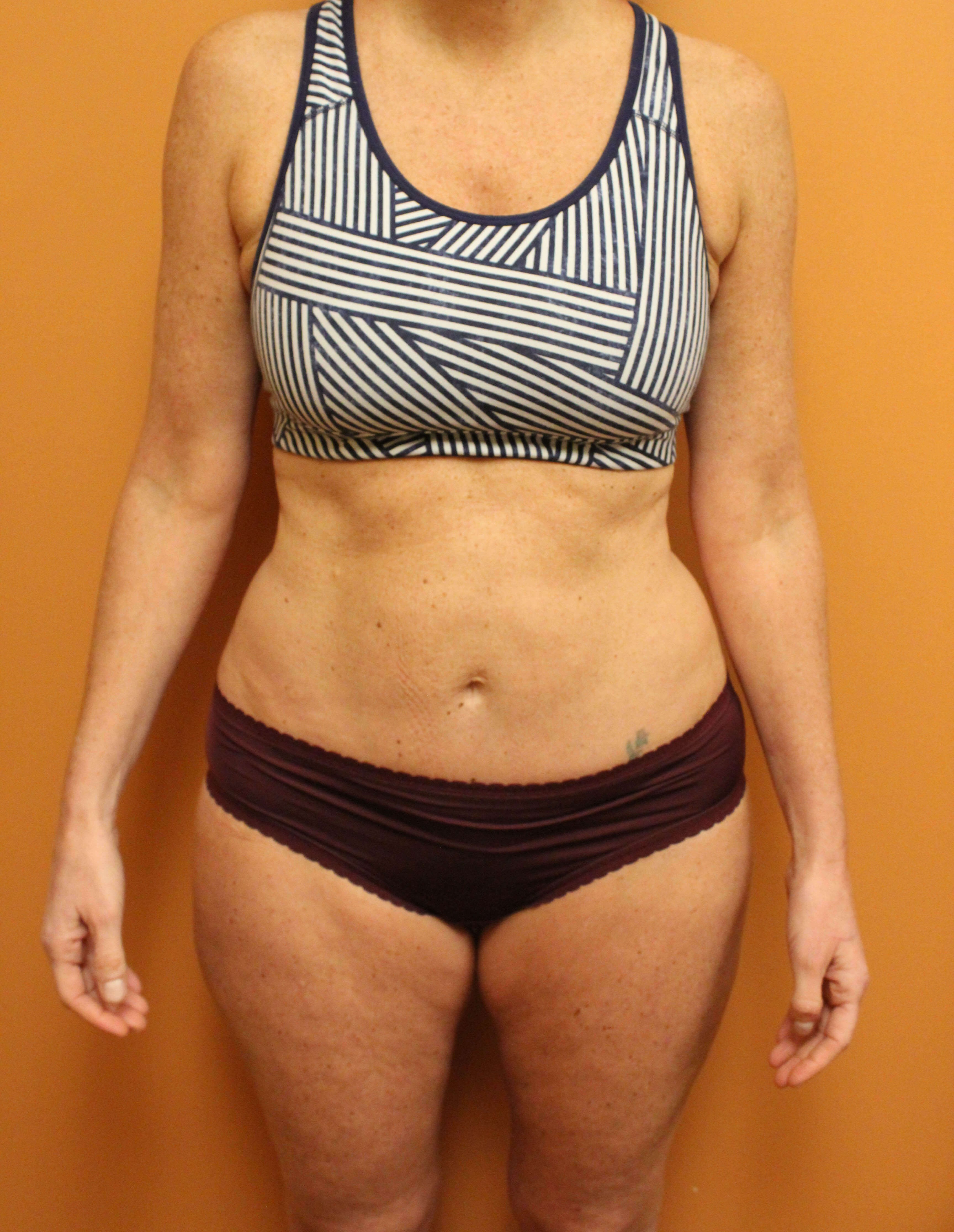 Liposuction and Mini Tuck After