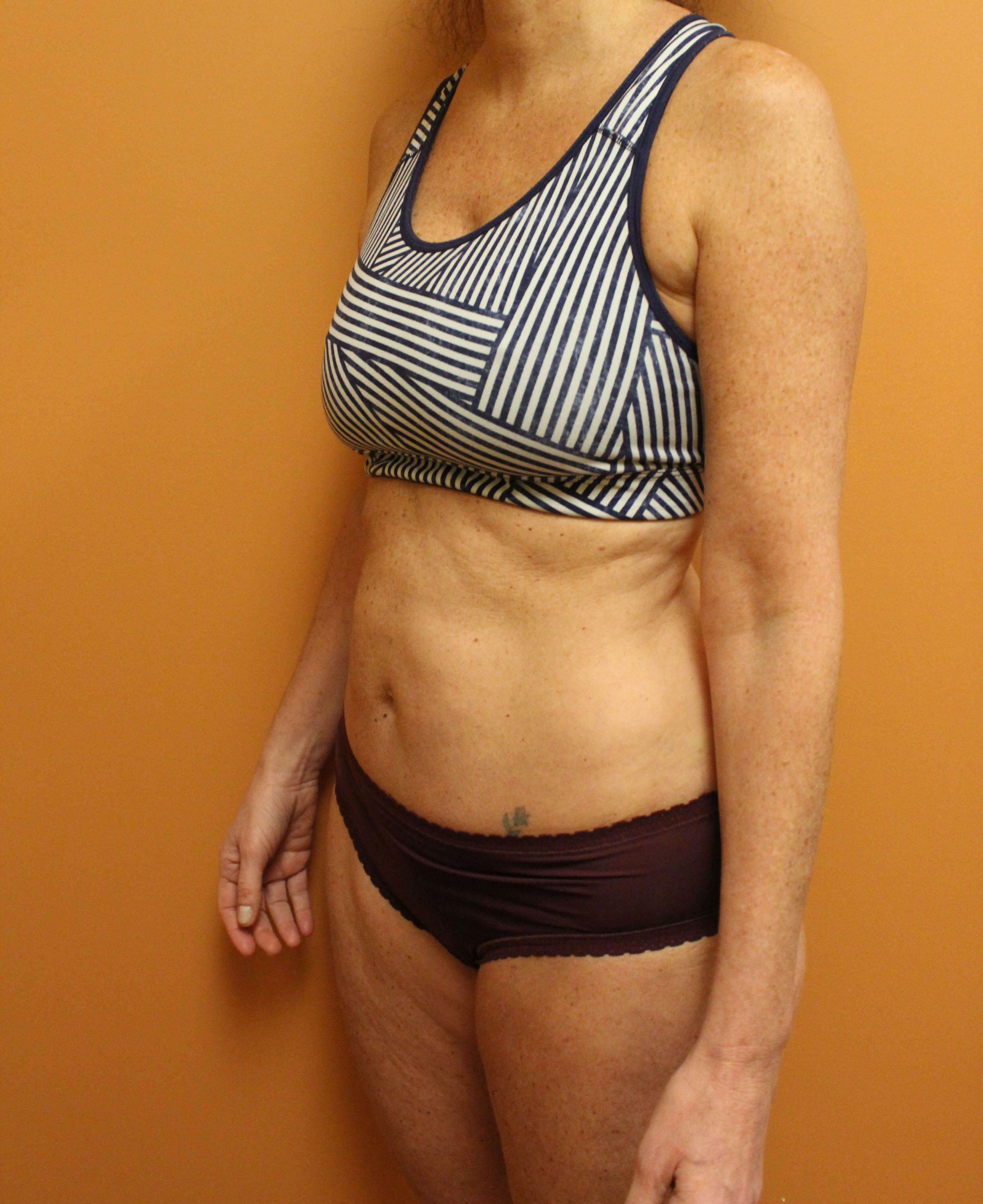 Liposuction and Mini Tuck After