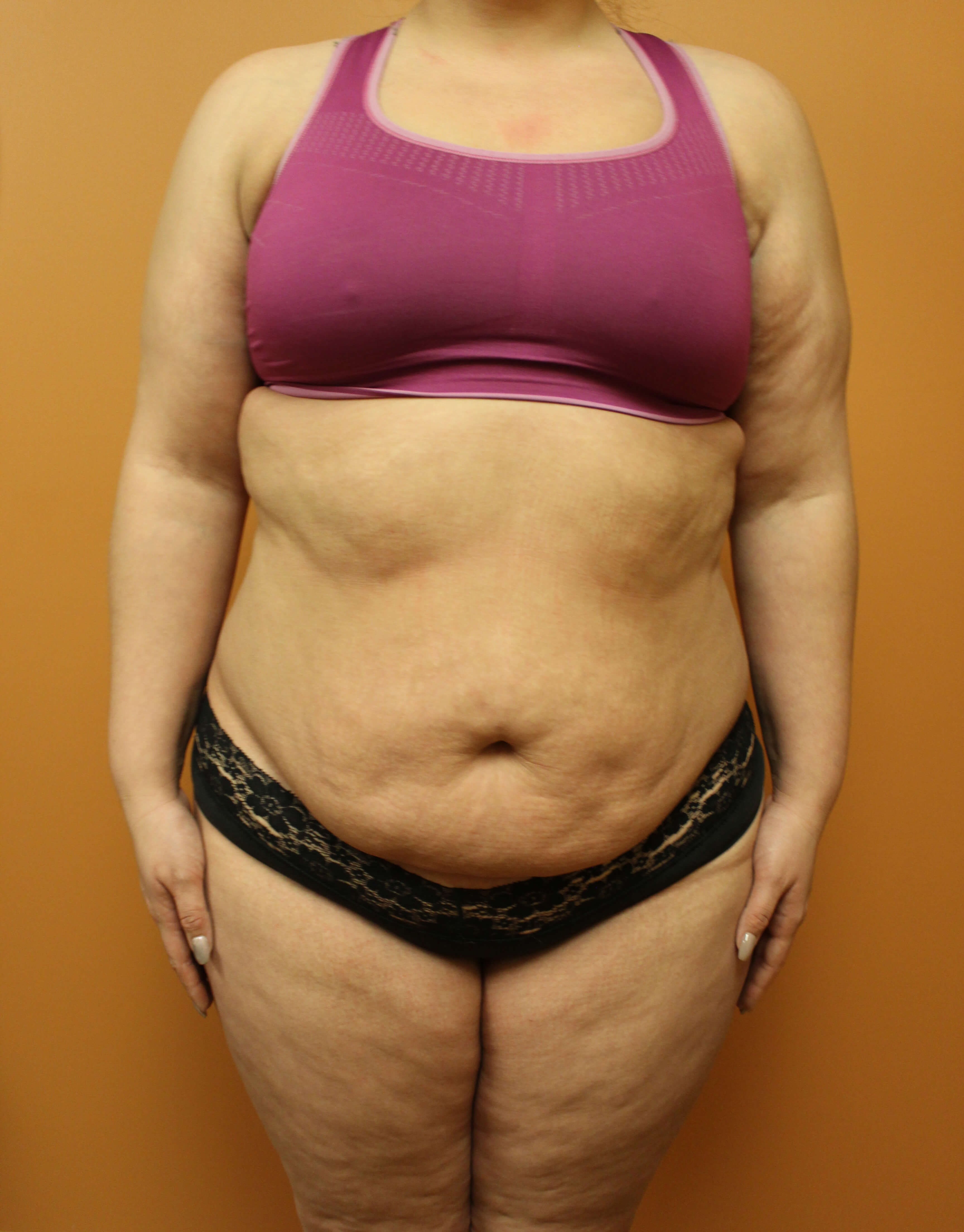 Tummy Tuck Surgery Before