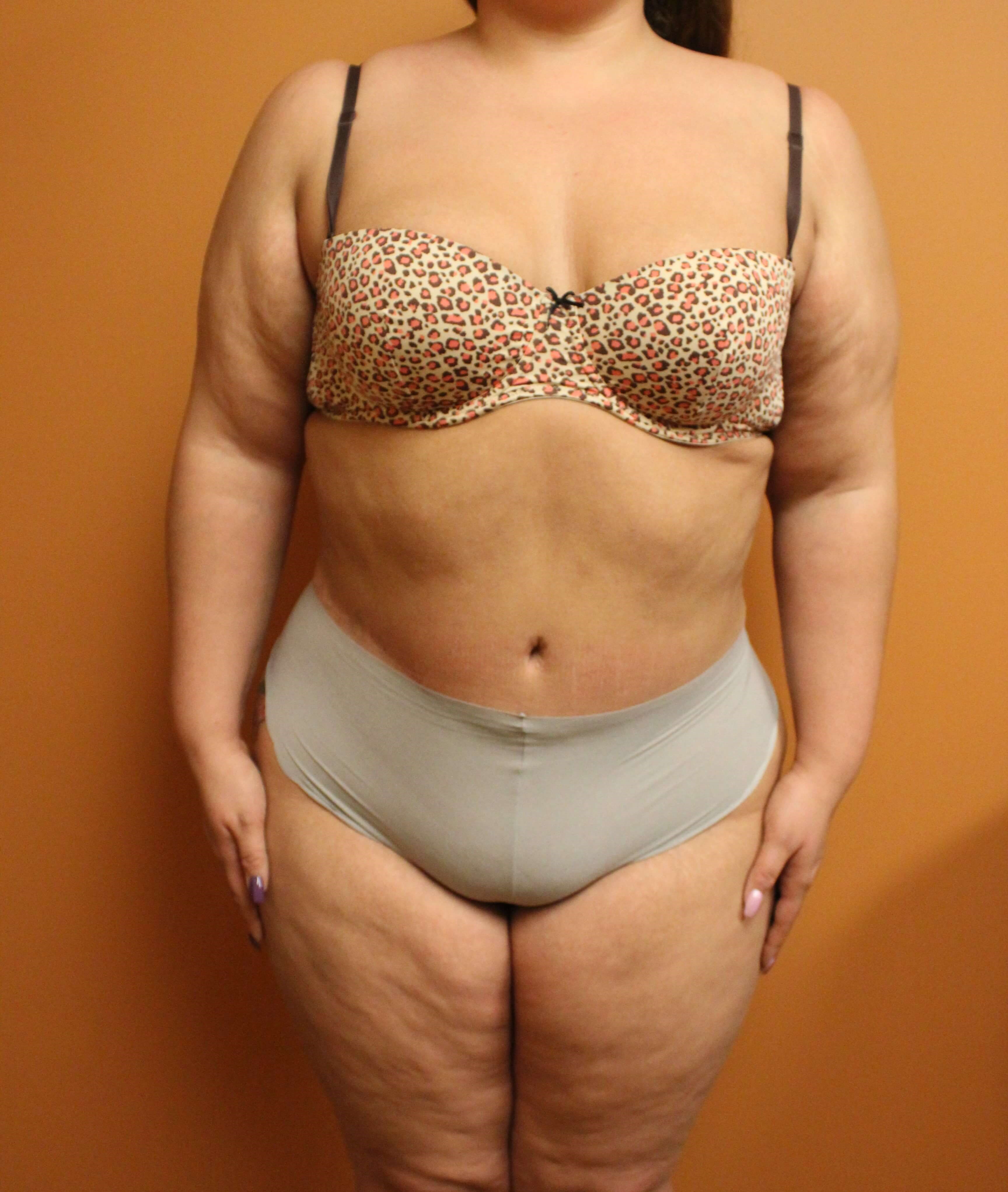 Tummy Tuck Surgery After