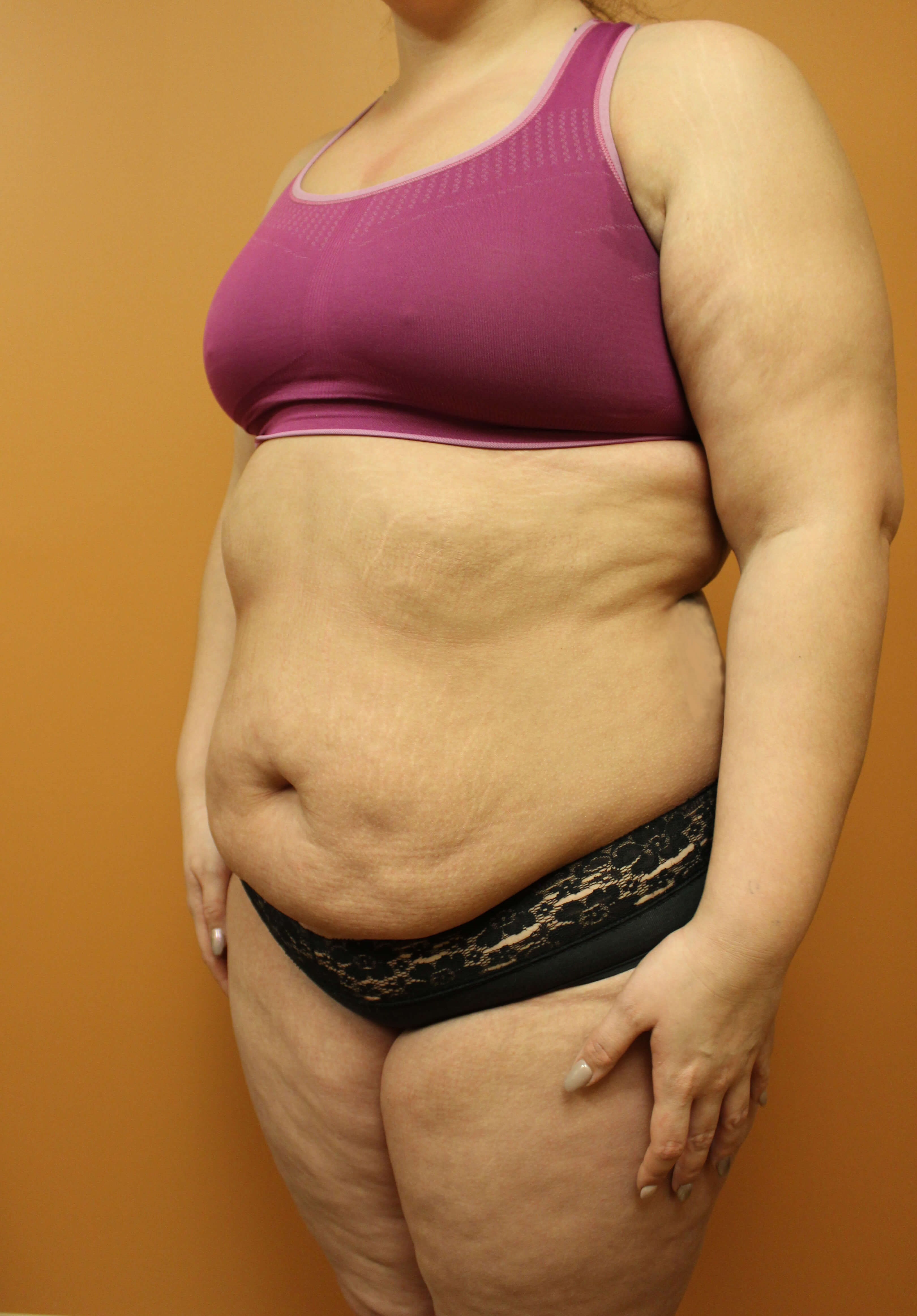 Tummy Tuck Surgery Before