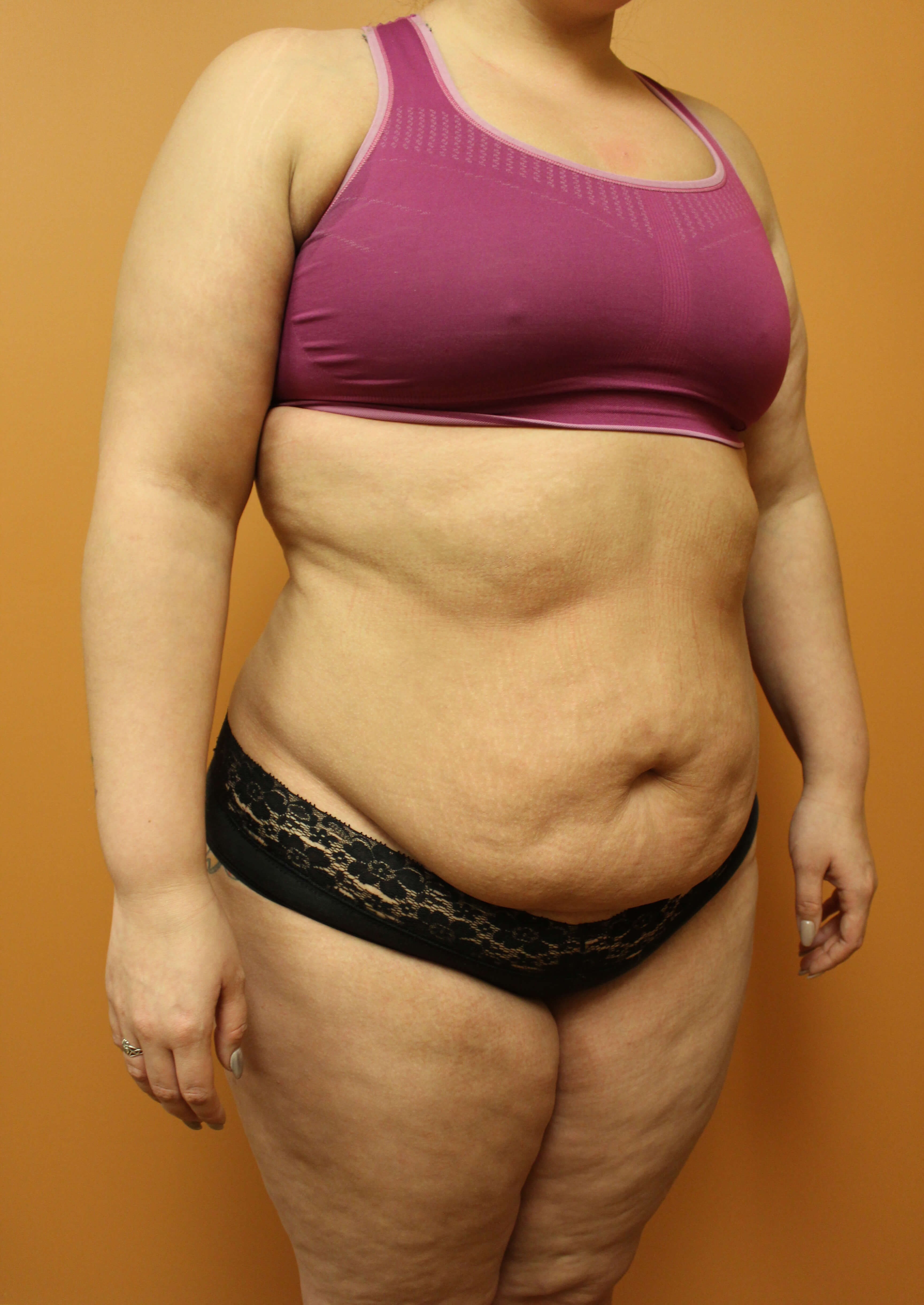 Tummy Tuck Surgery Before