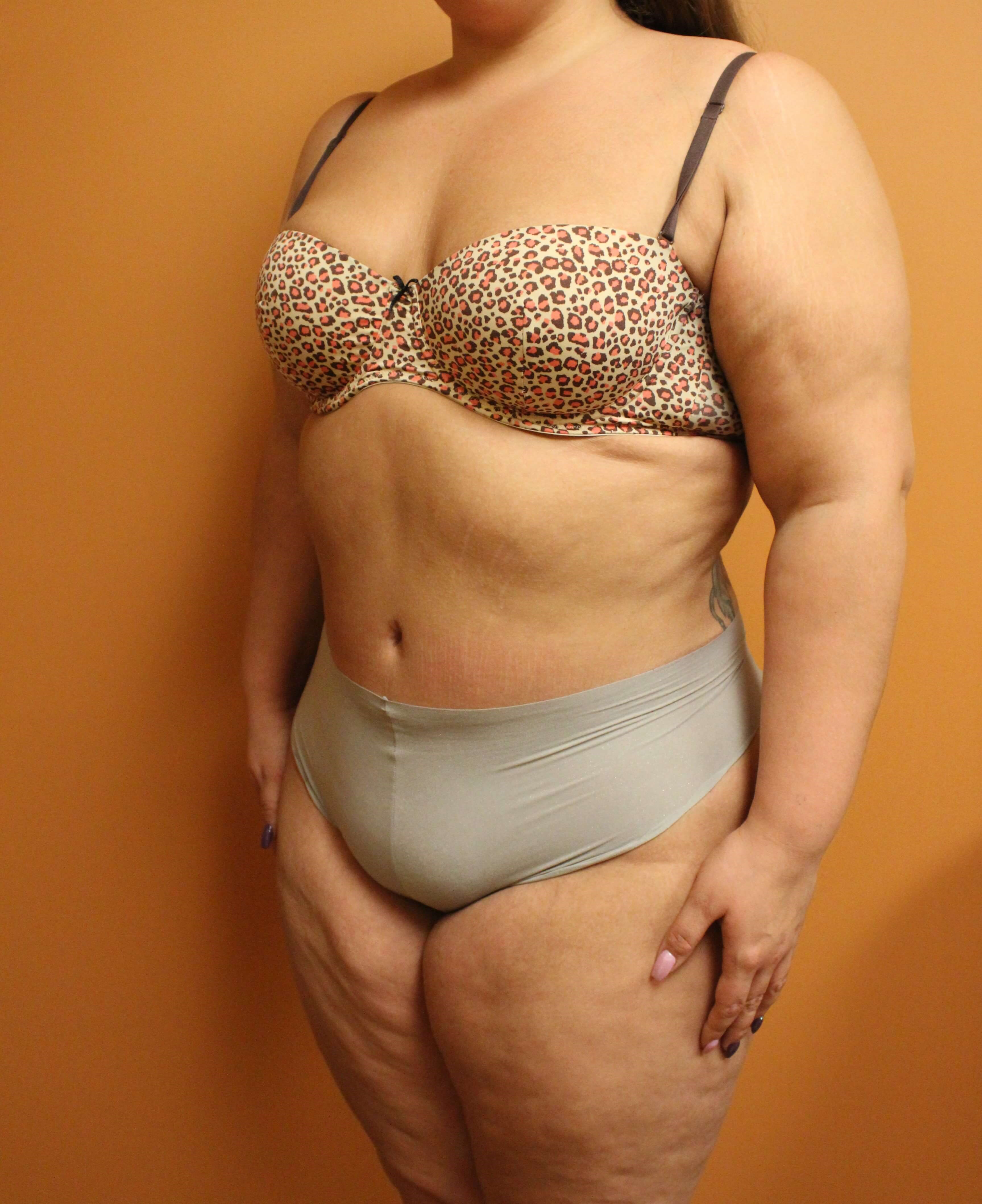 Tummy Tuck Surgery After