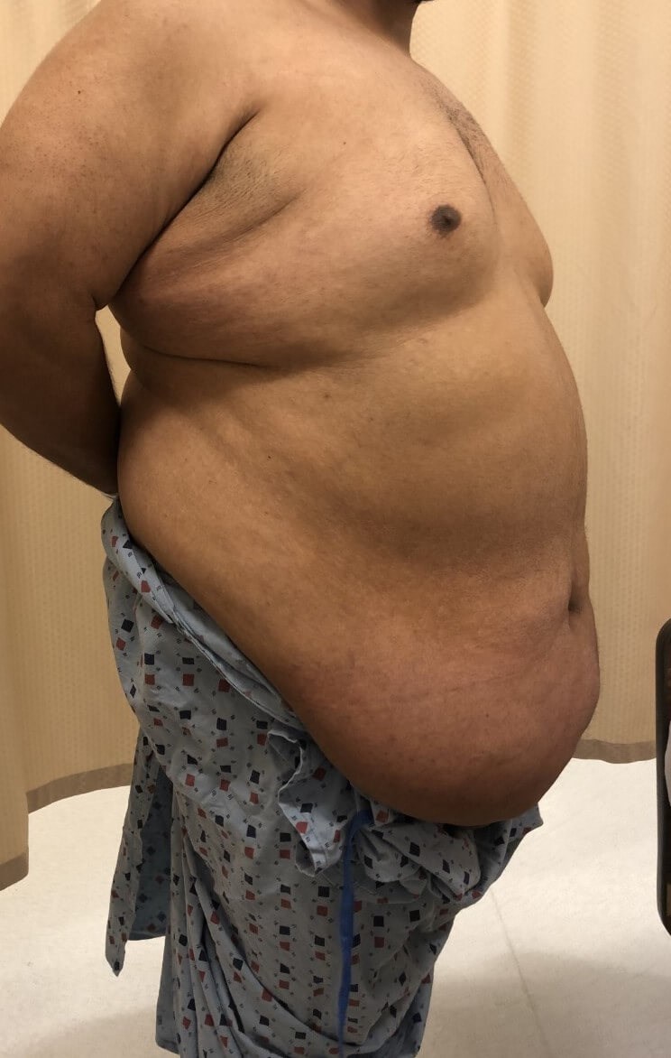 Male Tummy Tuck Before