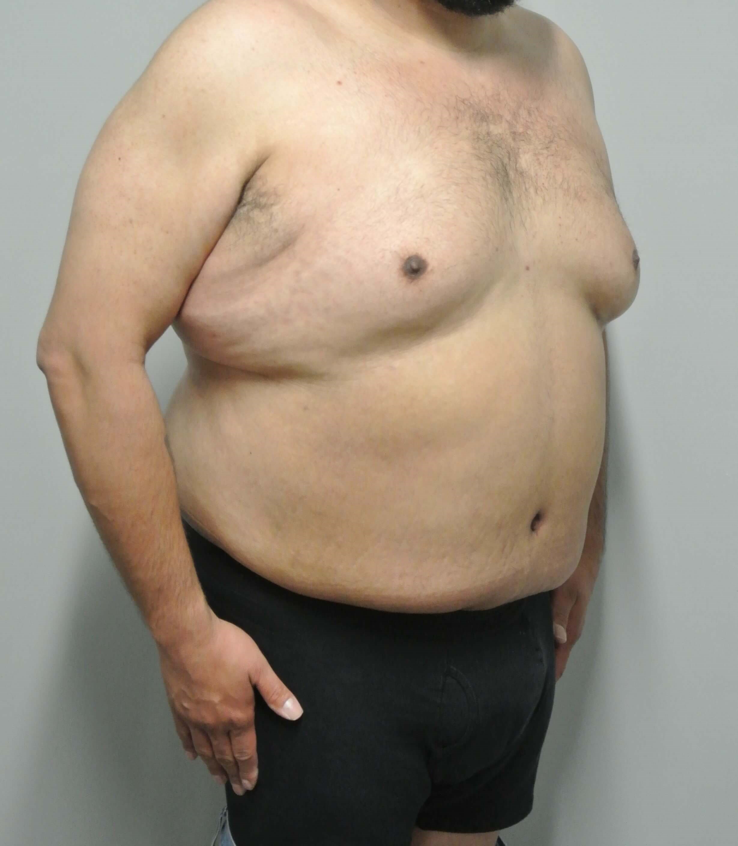 Male Tummy Tuck After