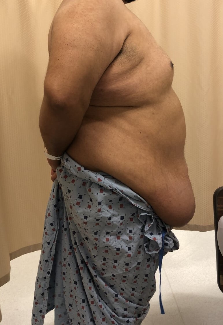 Male Tummy Tuck Before