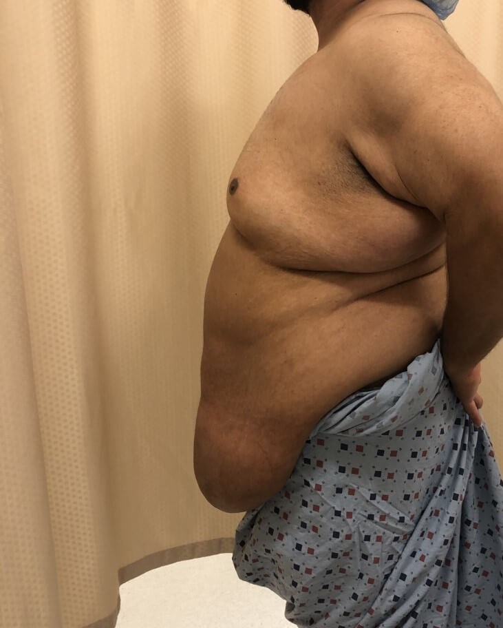 Male Tummy Tuck Before