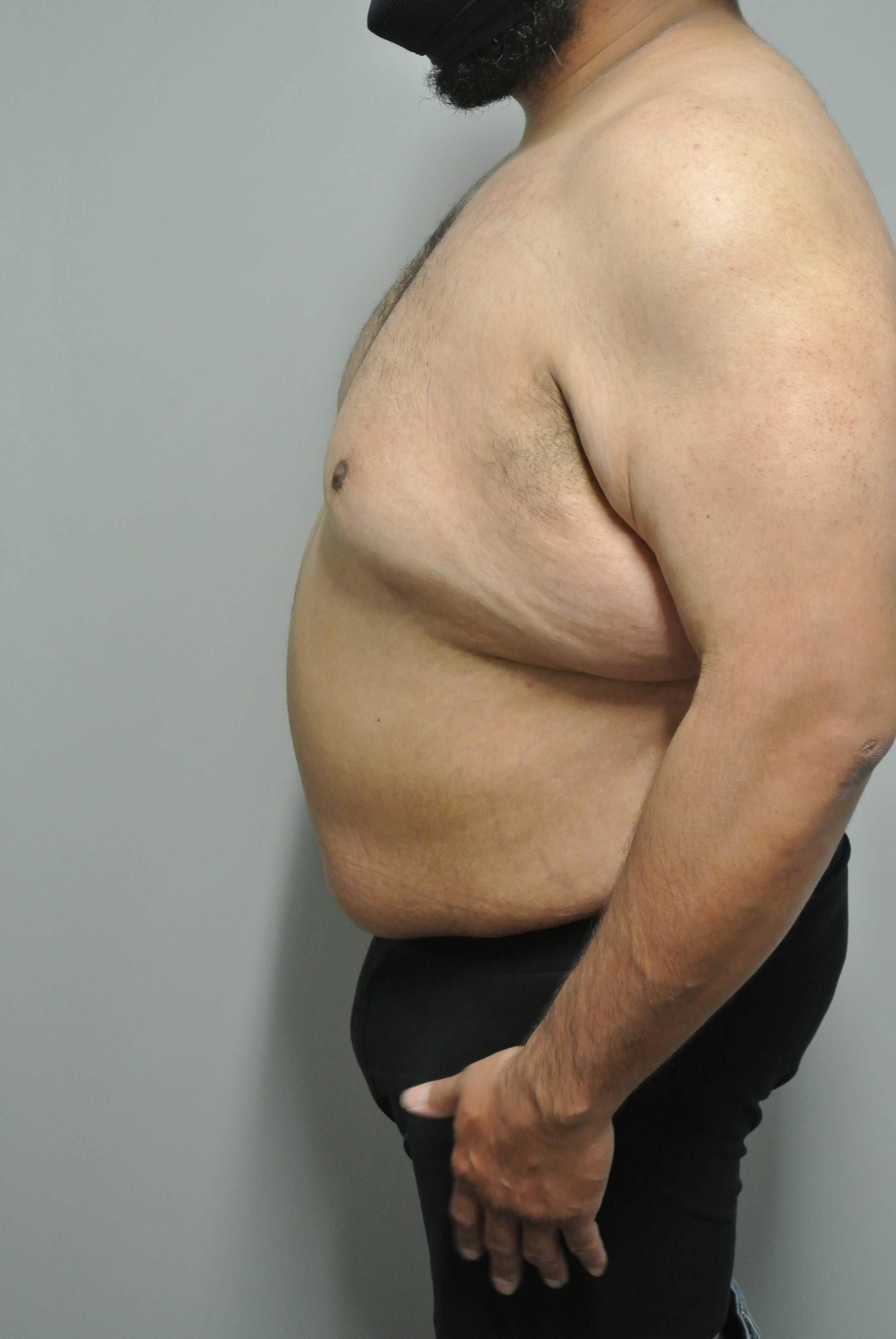 Male Tummy Tuck After