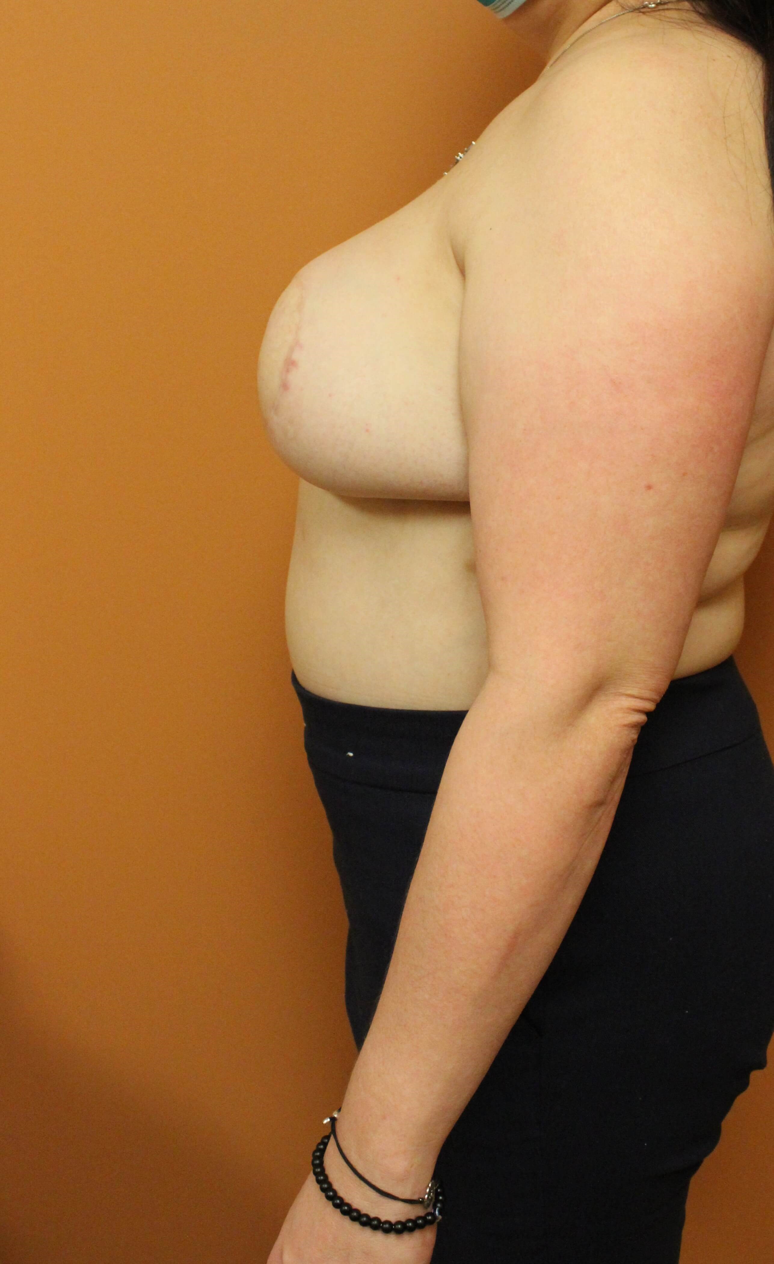 Breast DIEP Flap After