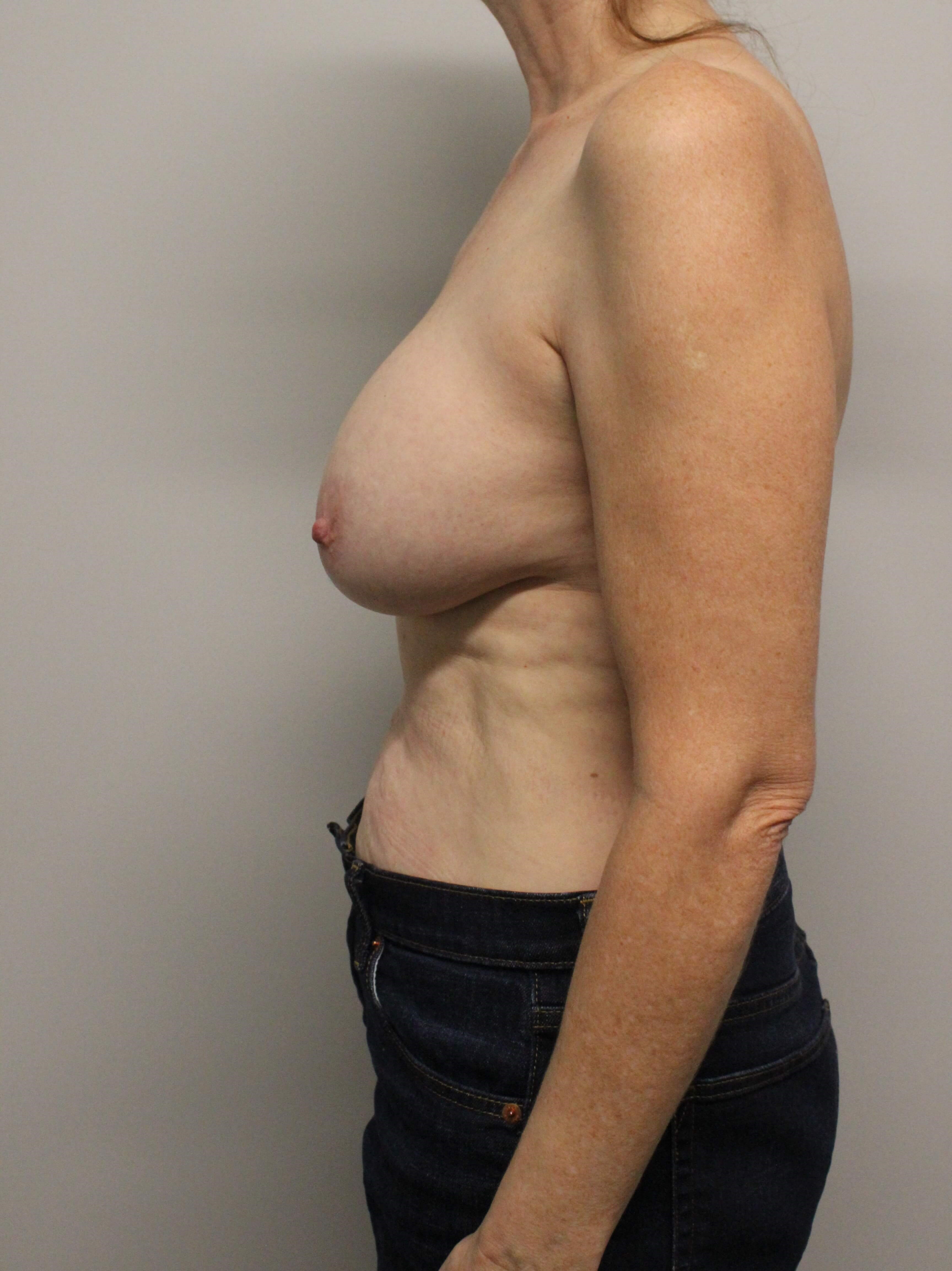 Tissue Expander to Implant Before