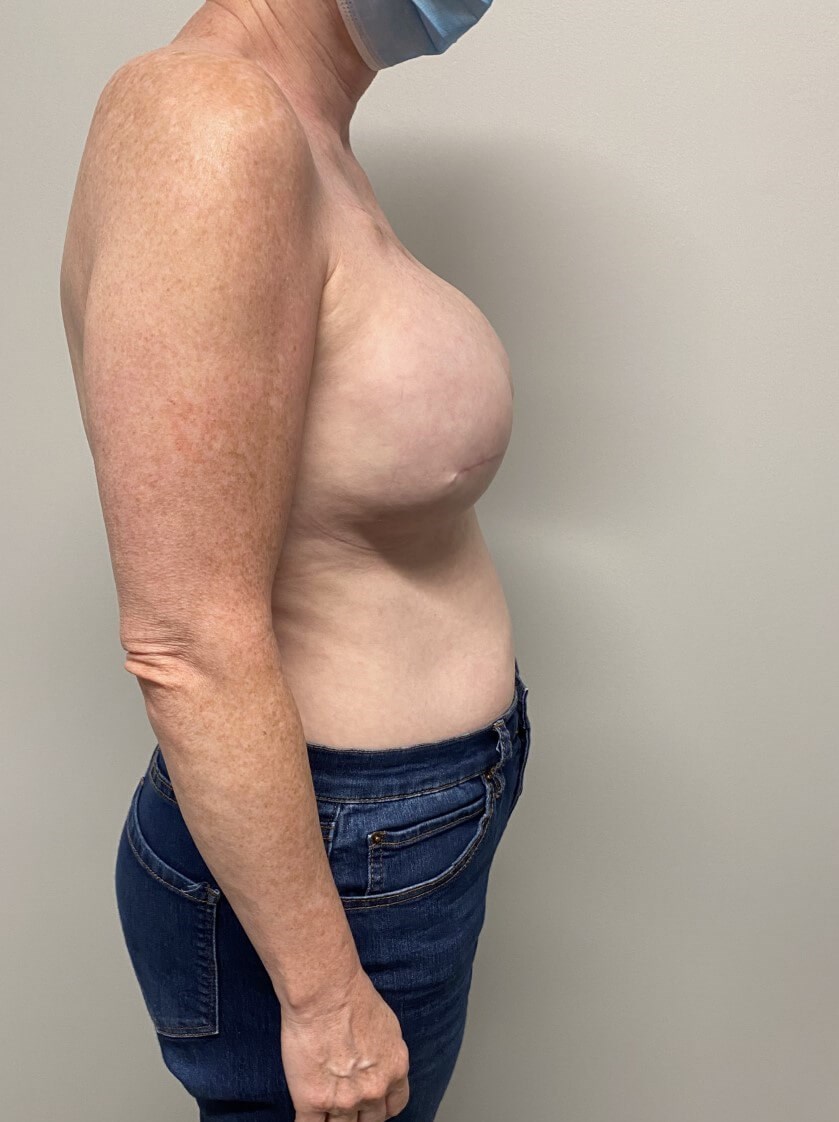 Tissue Expander & Alloderm After