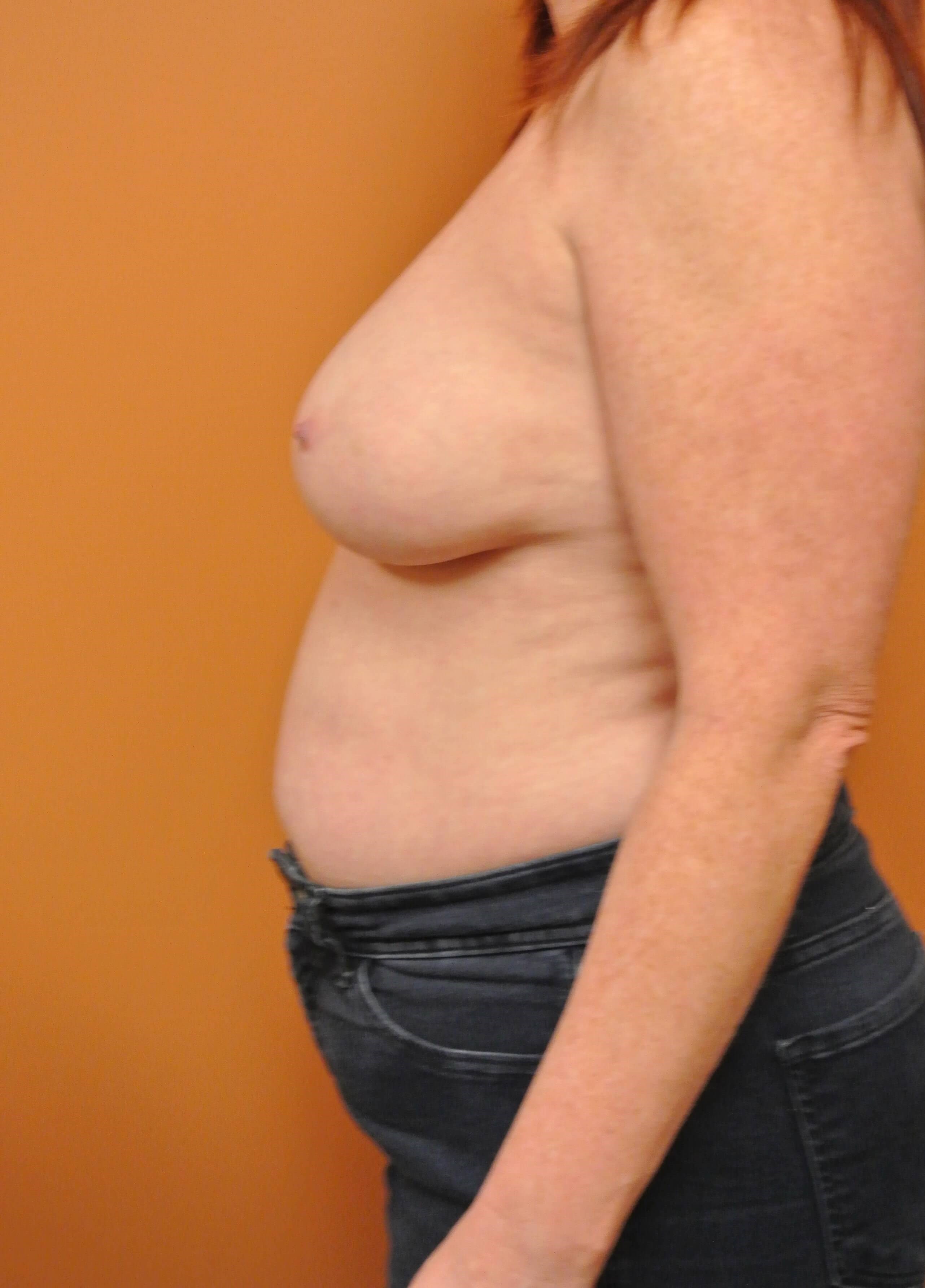 Tissue Expander & Alloderm Before