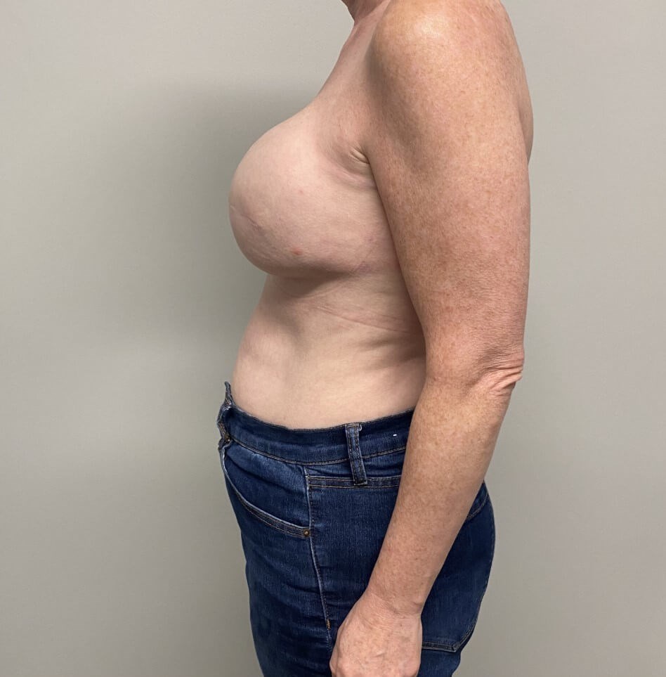 Tissue Expander & Alloderm After