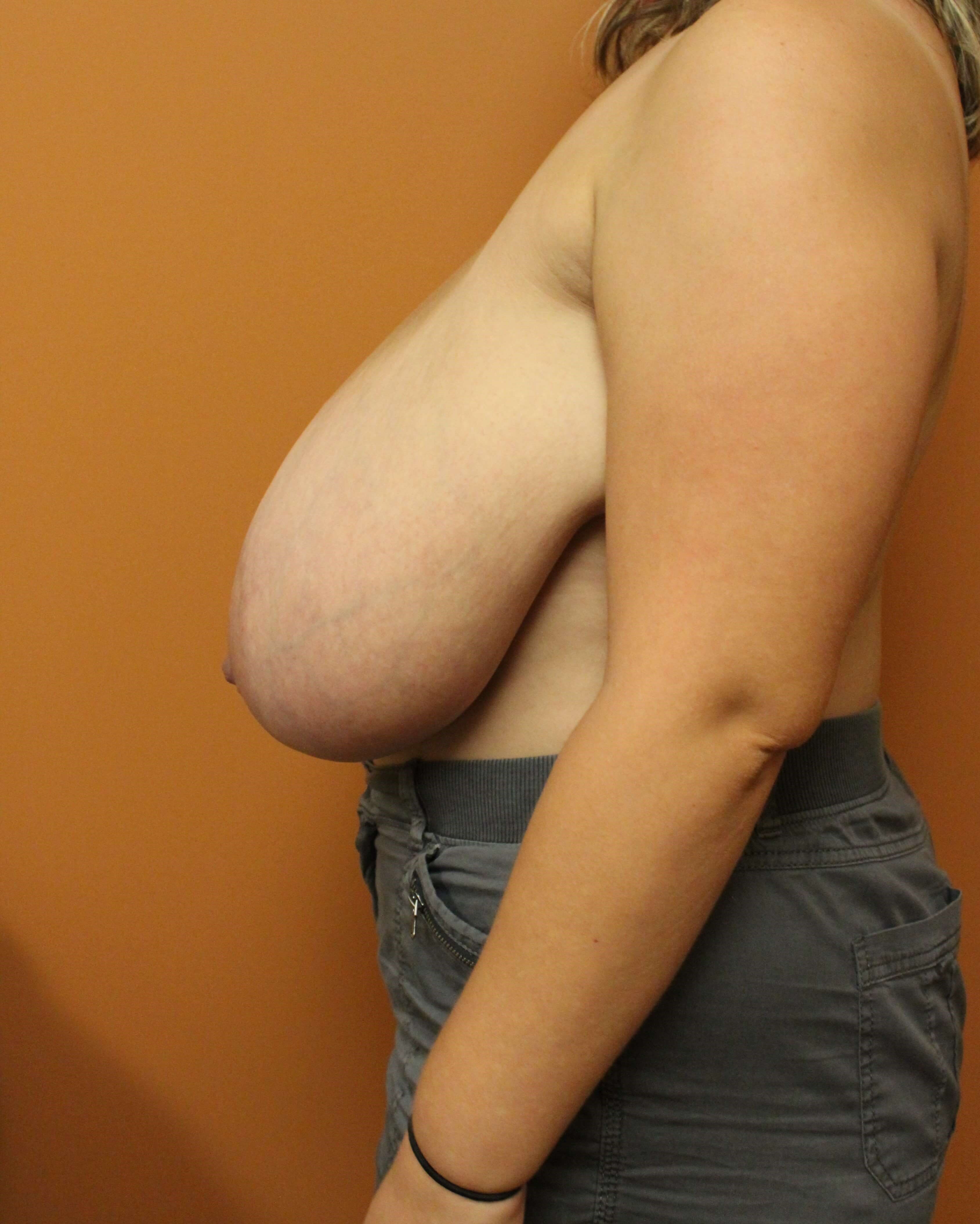 Breast Reduction Before