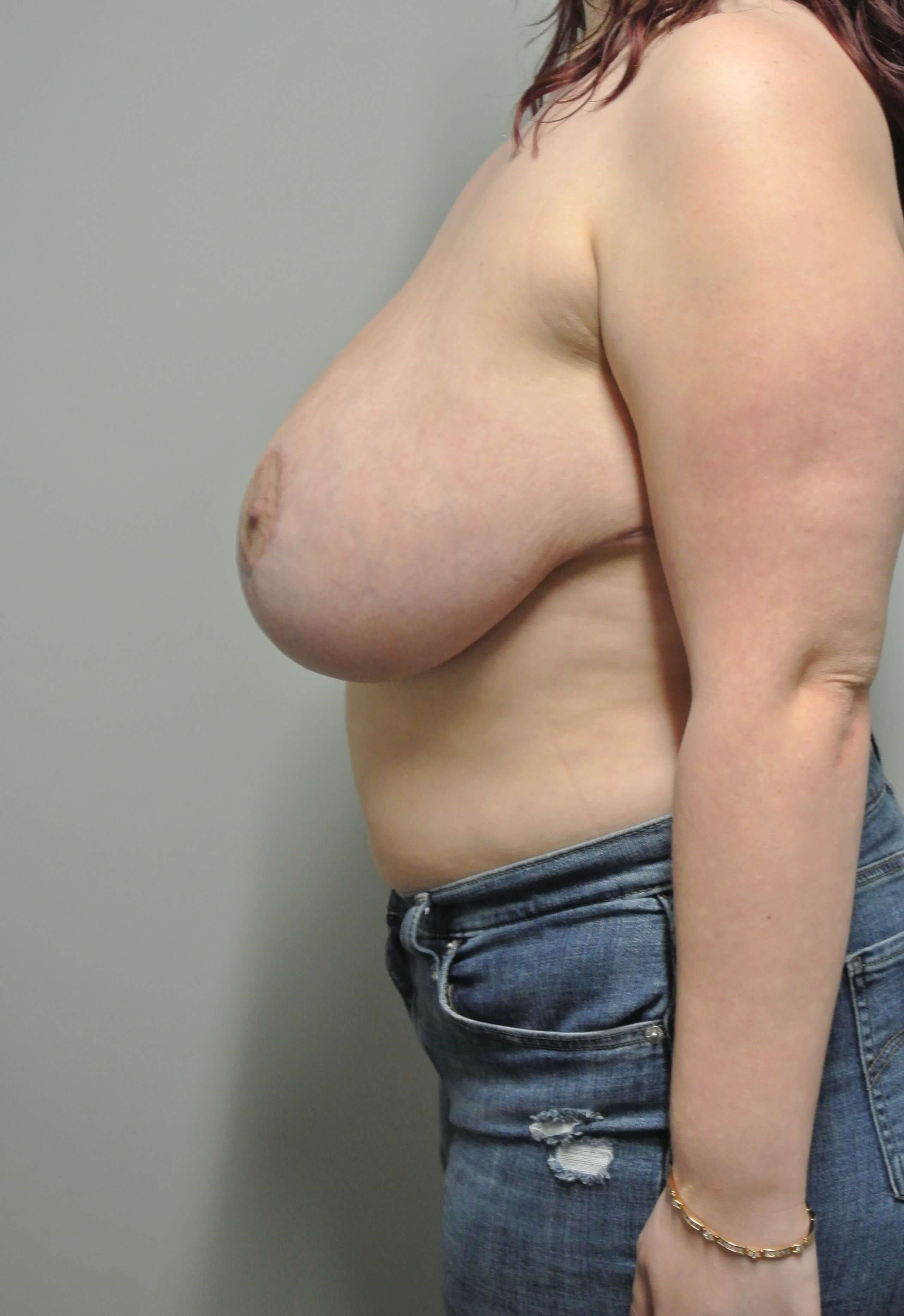 Breast Reduction After