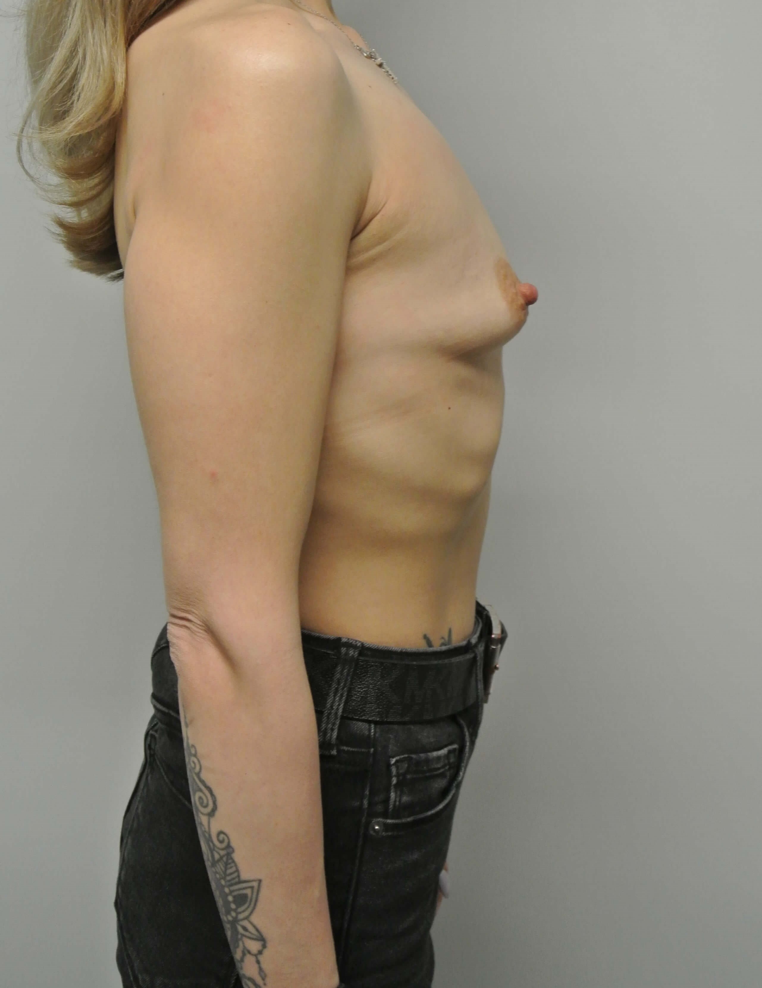 Periareolar Augmentation Before