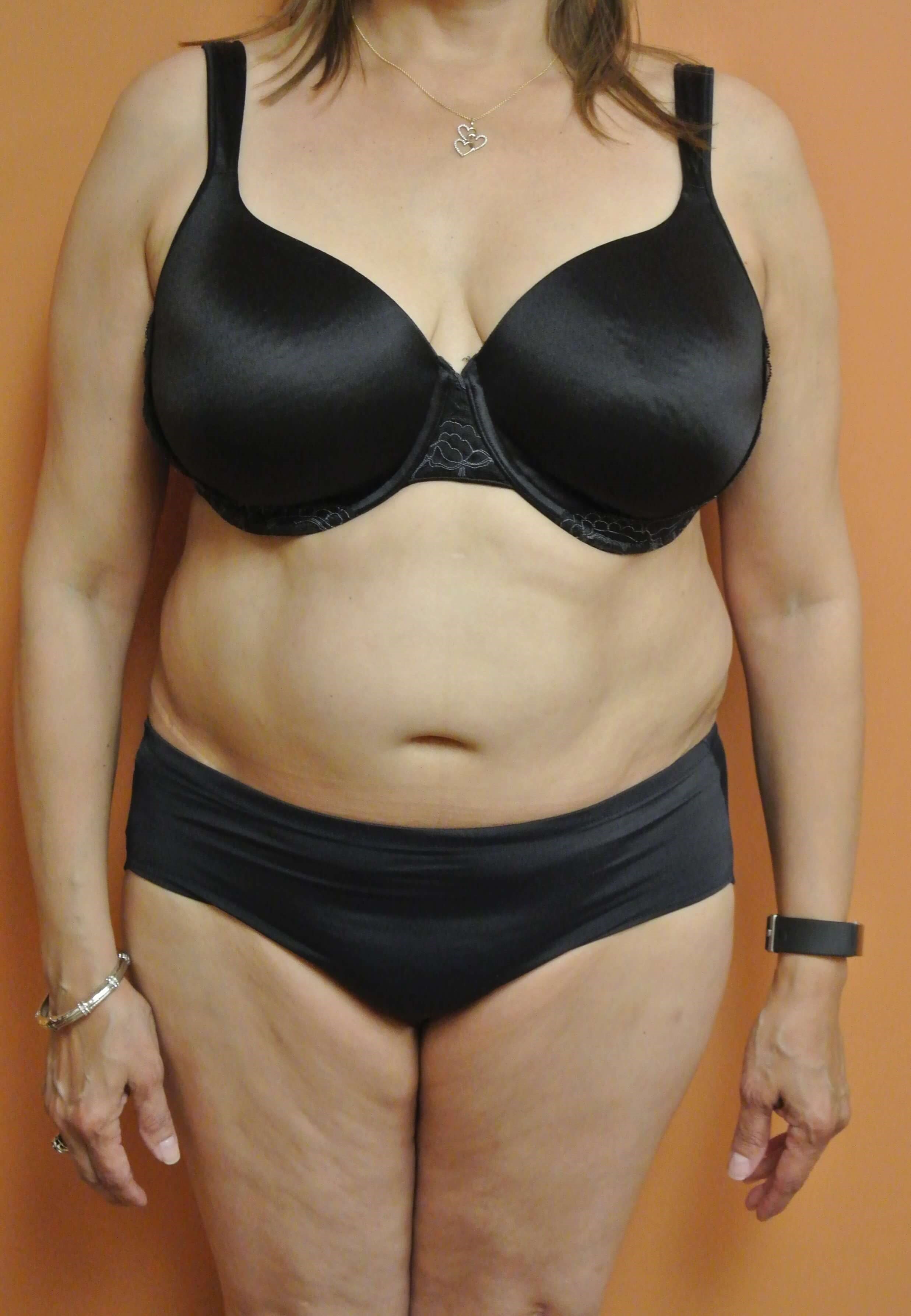 BodyTite Abdomen Flanks Back Before