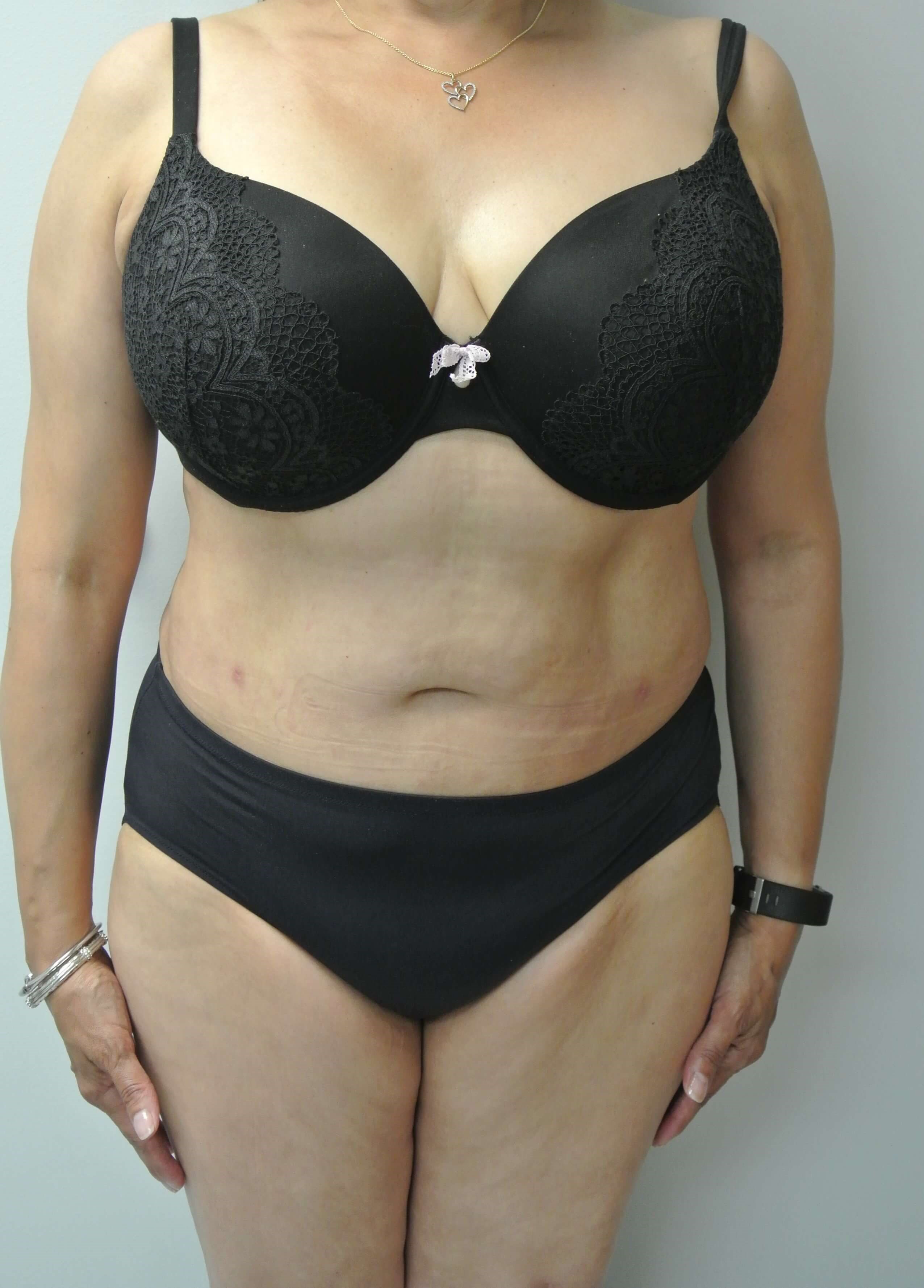 BodyTite Abdomen Flanks Back After BodyTite