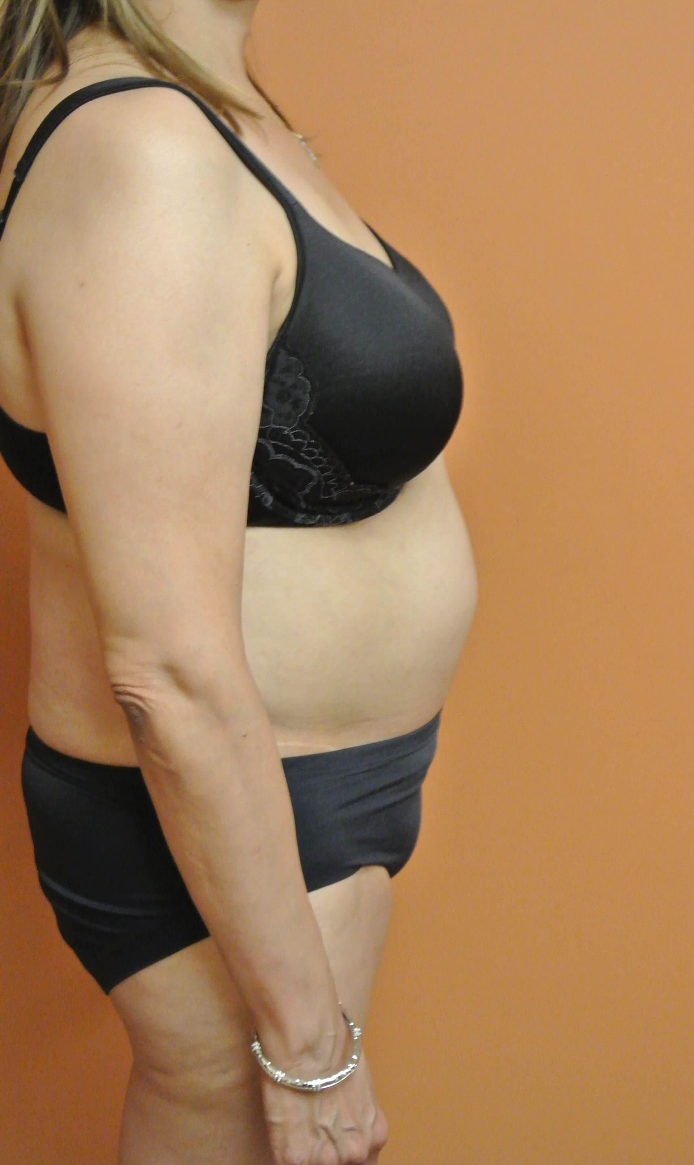 BodyTite Abdomen Flanks Back Before