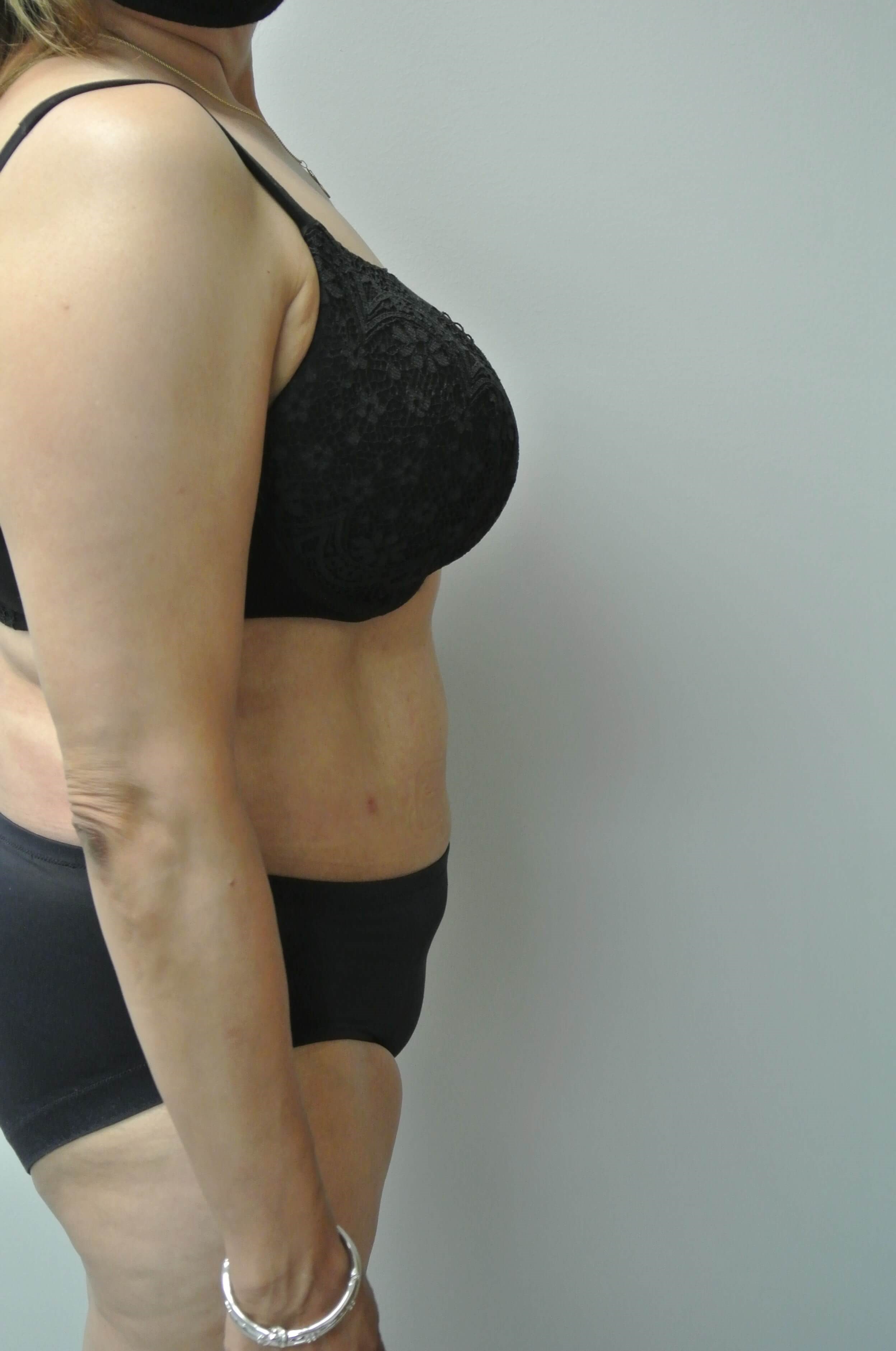 BodyTite Abdomen Flanks Back After BodyTite