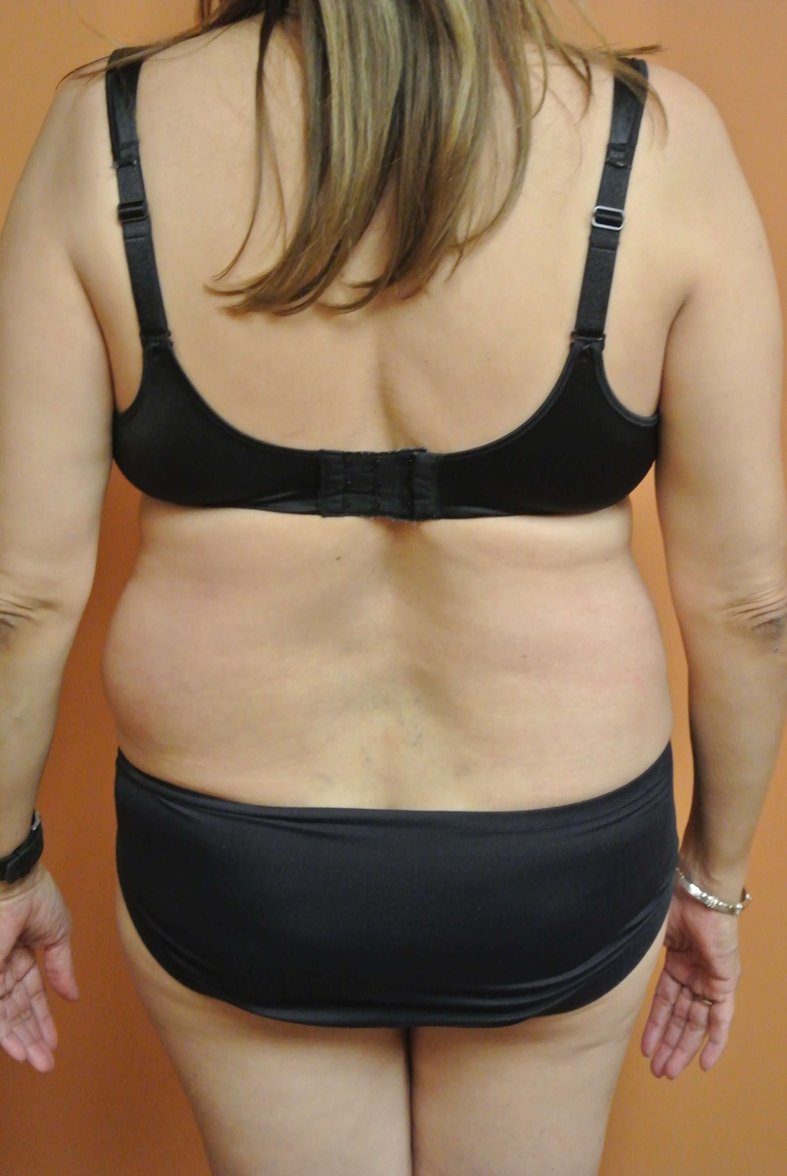 BodyTite Abdomen Flanks Back Before