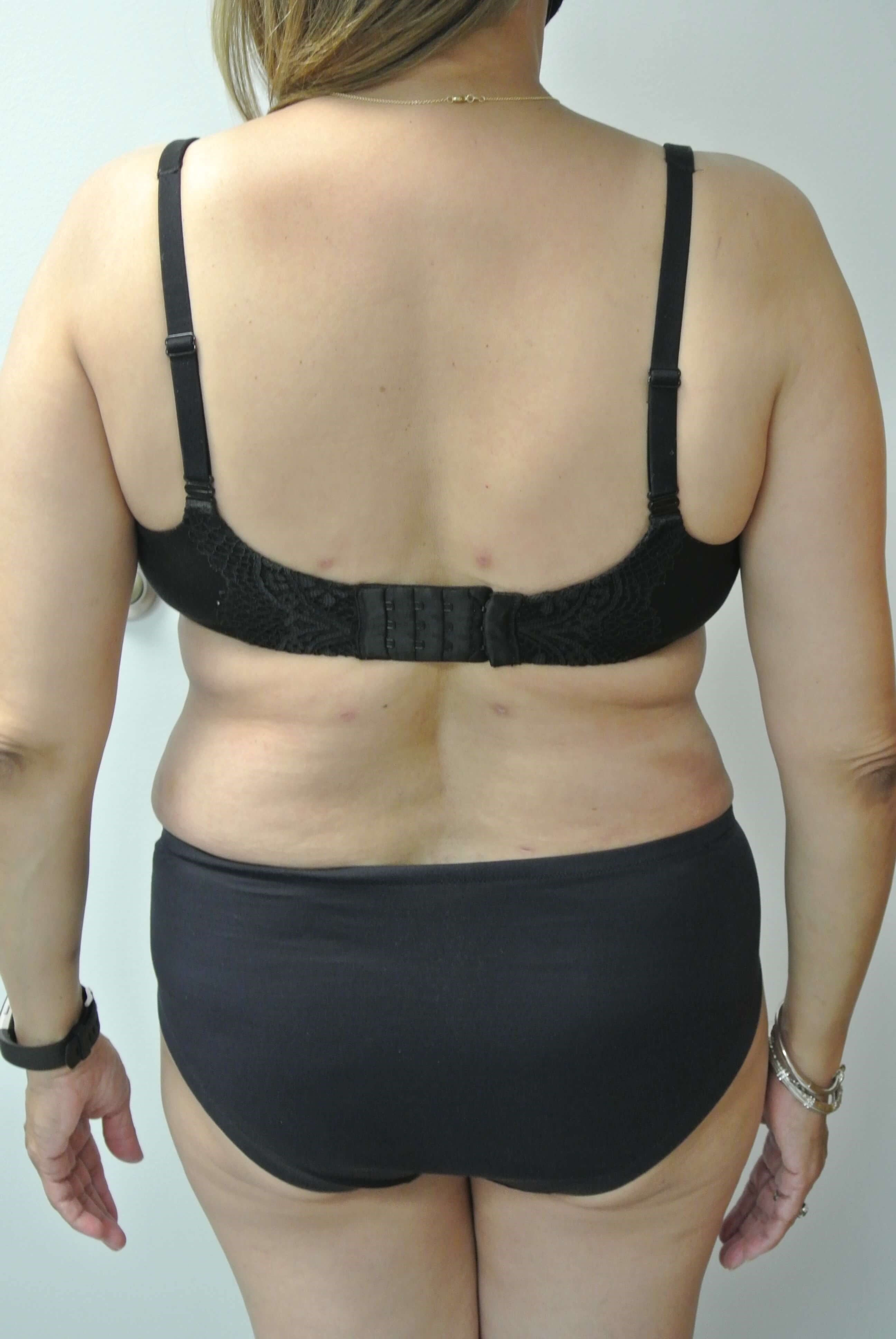 BodyTite Abdomen Flanks Back After BodyTite