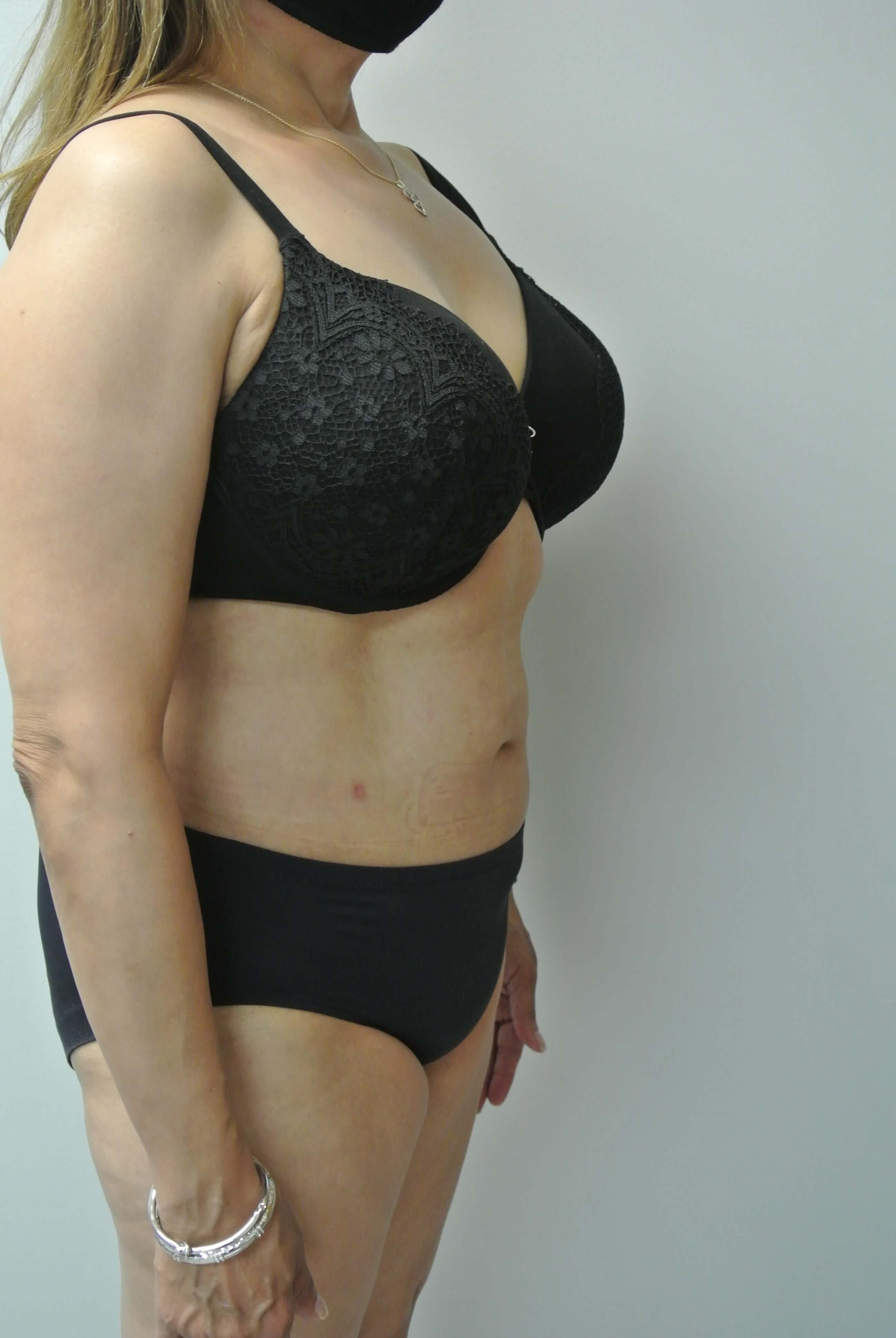 BodyTite Abdomen Flanks Back After BodyTite