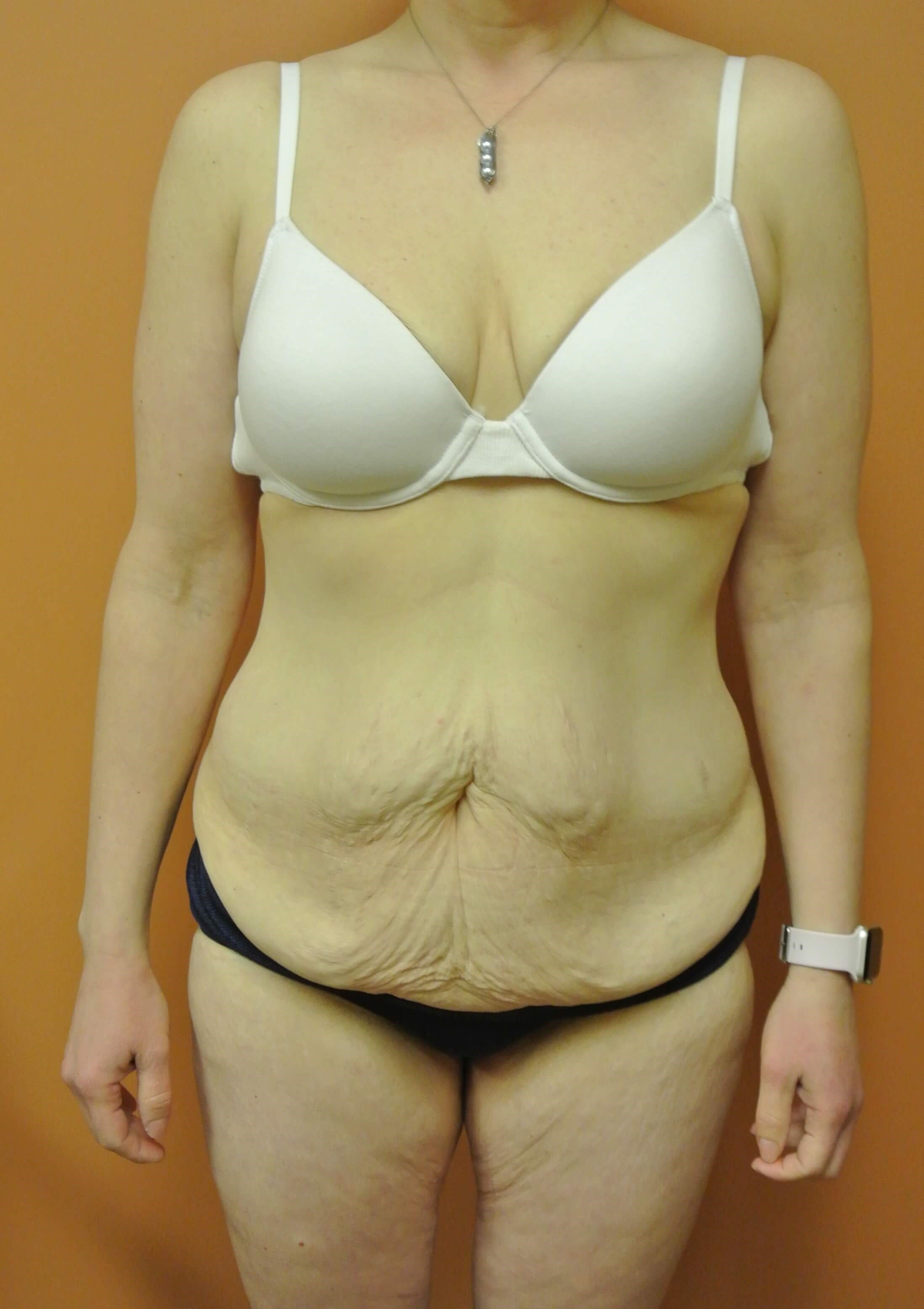 Mommy Makeover Tummy Tuck Before