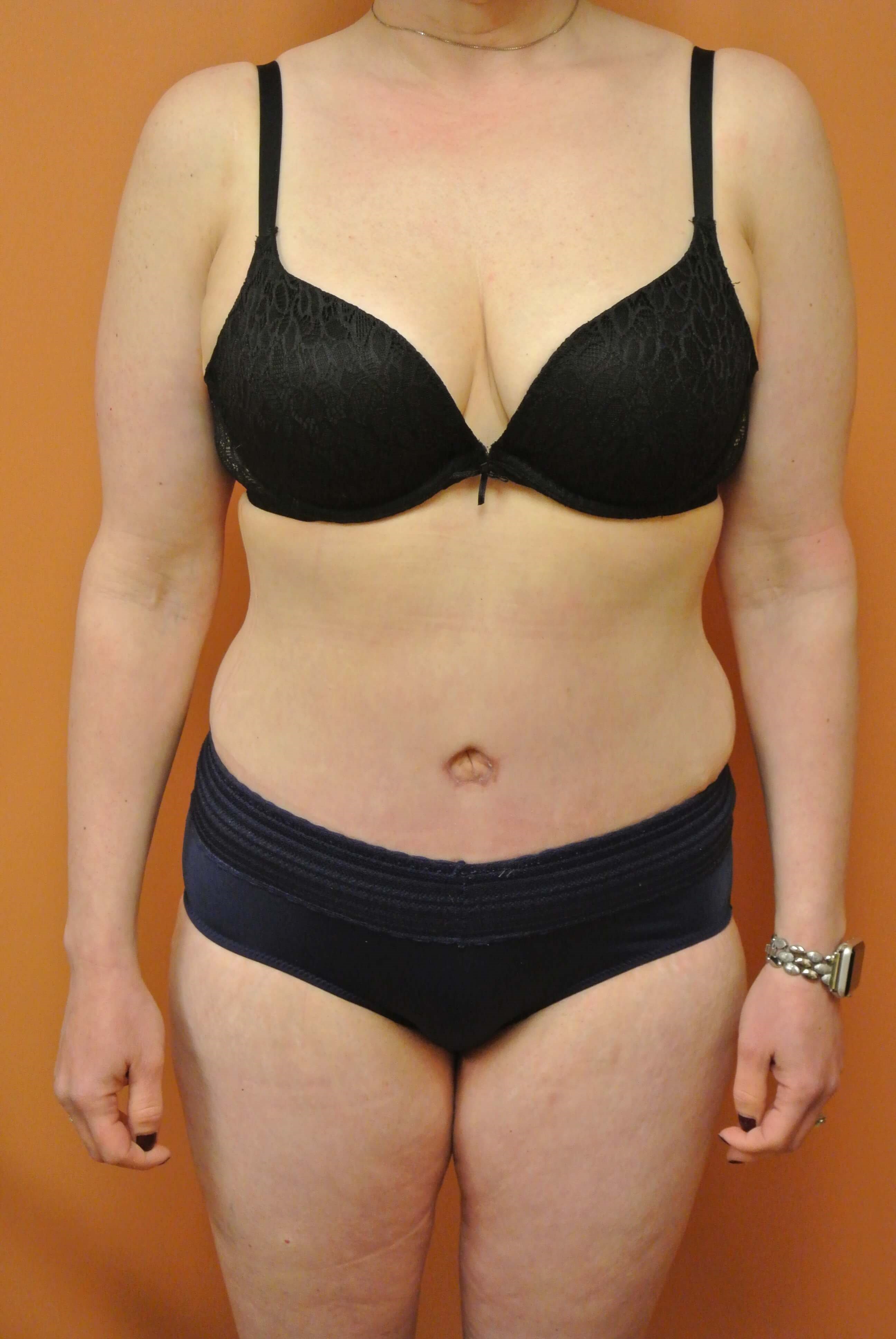 Mommy Makeover Tummy Tuck After Tummy Tuck